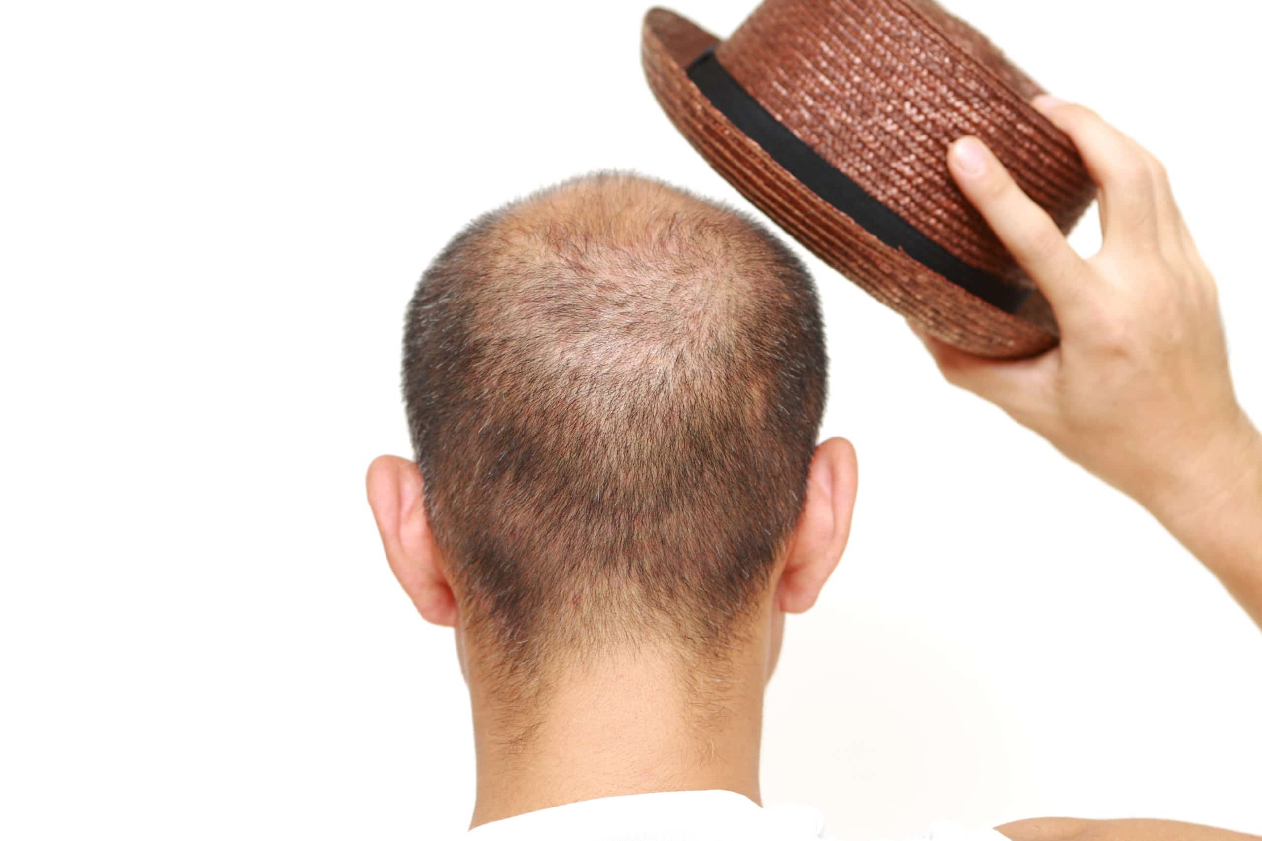man with hair loss lifting his hat