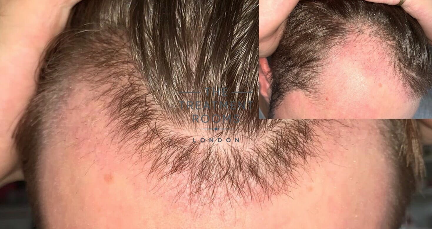 hair shedding 1 month post hair transplant