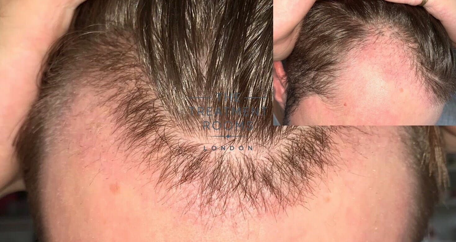 Hair Transplant Recovery Timeline  0  14 Months Photos