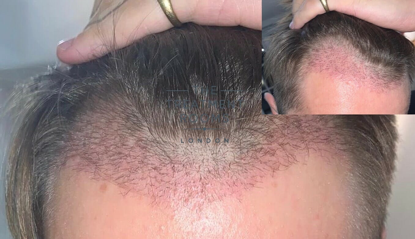 Hair Restoration Near Me