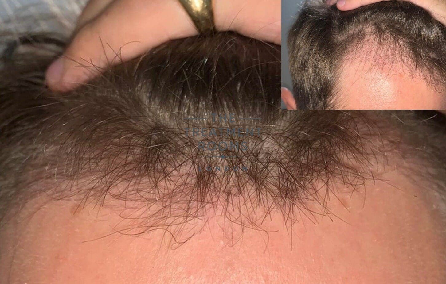 hair shedding 3 months post hair transplant