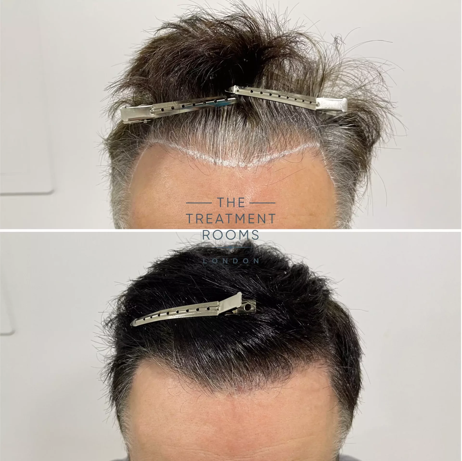 hair transplant clinic london repair 1264 grafts