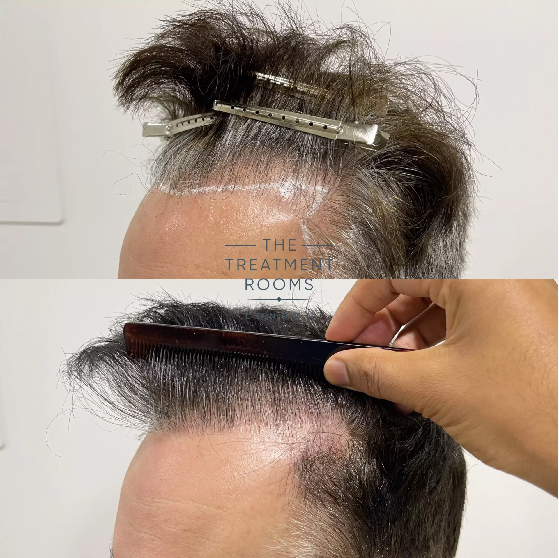 hair transplant hairline repair 1264 grafts