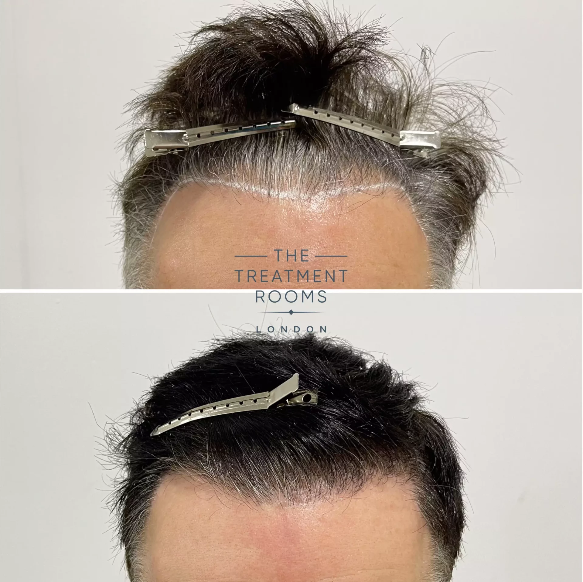 hair transplant repair 1264 grafts