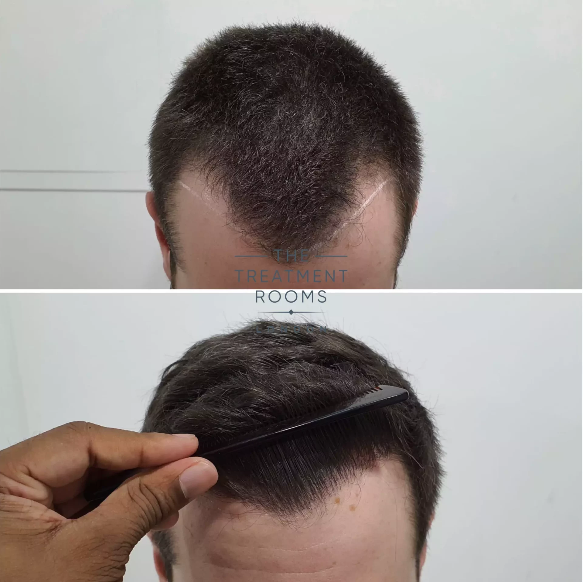 hair transplant 1297 grafts before and after
