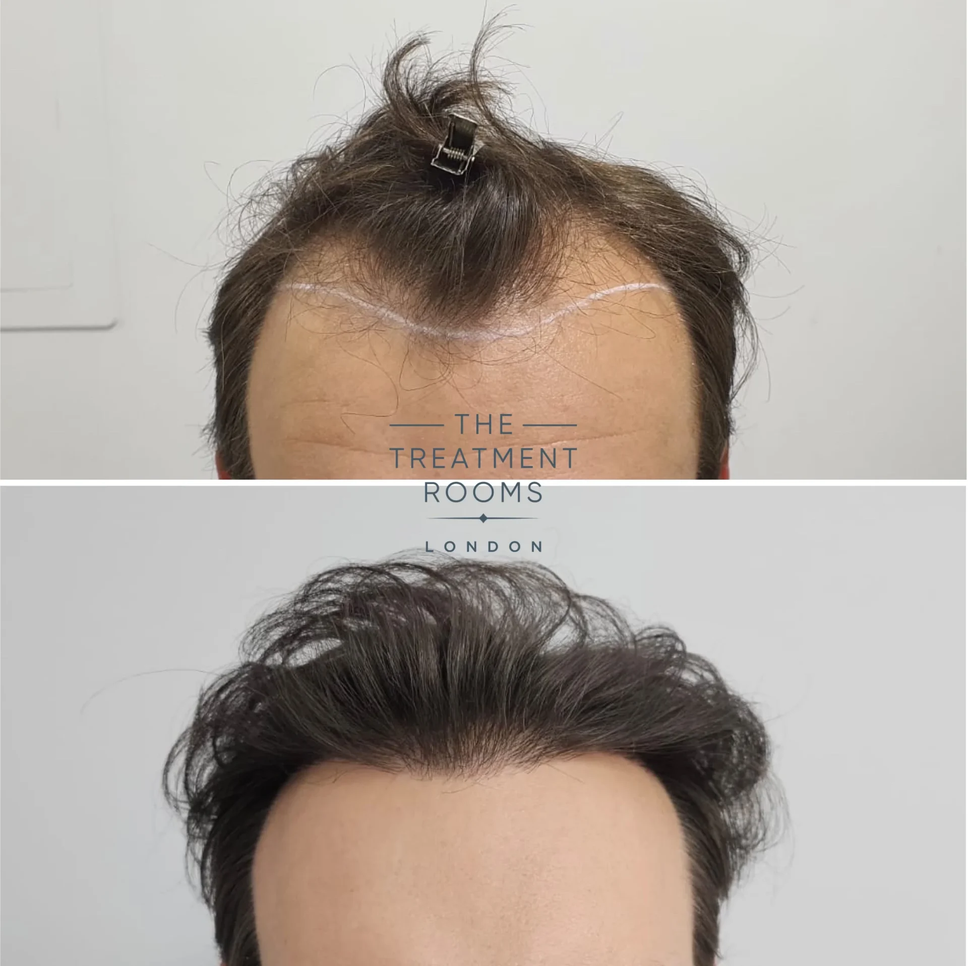 hair transplant 1385 grafts before and after