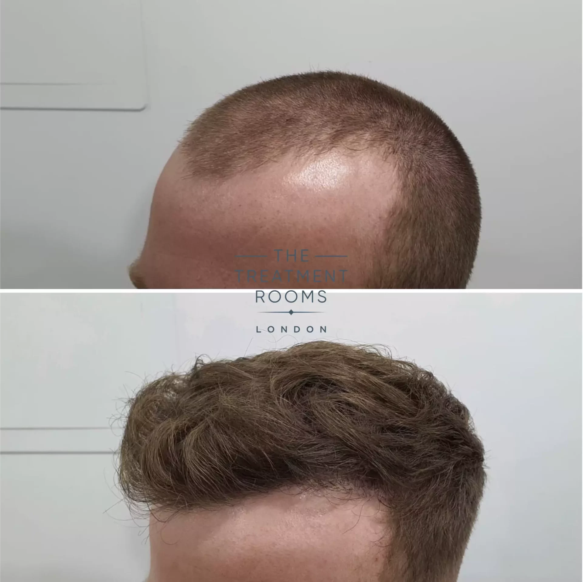 hair transplant 1539 grafts before and after