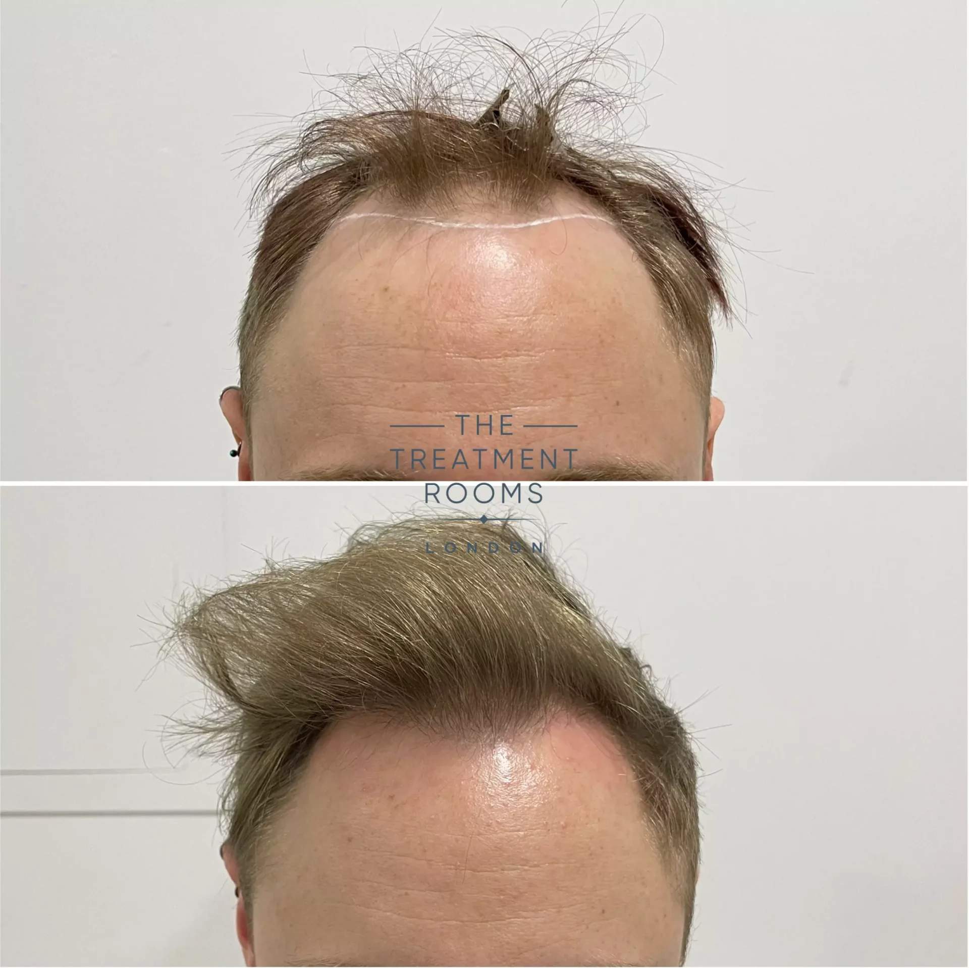 hair transplant 1693 grafts before and after