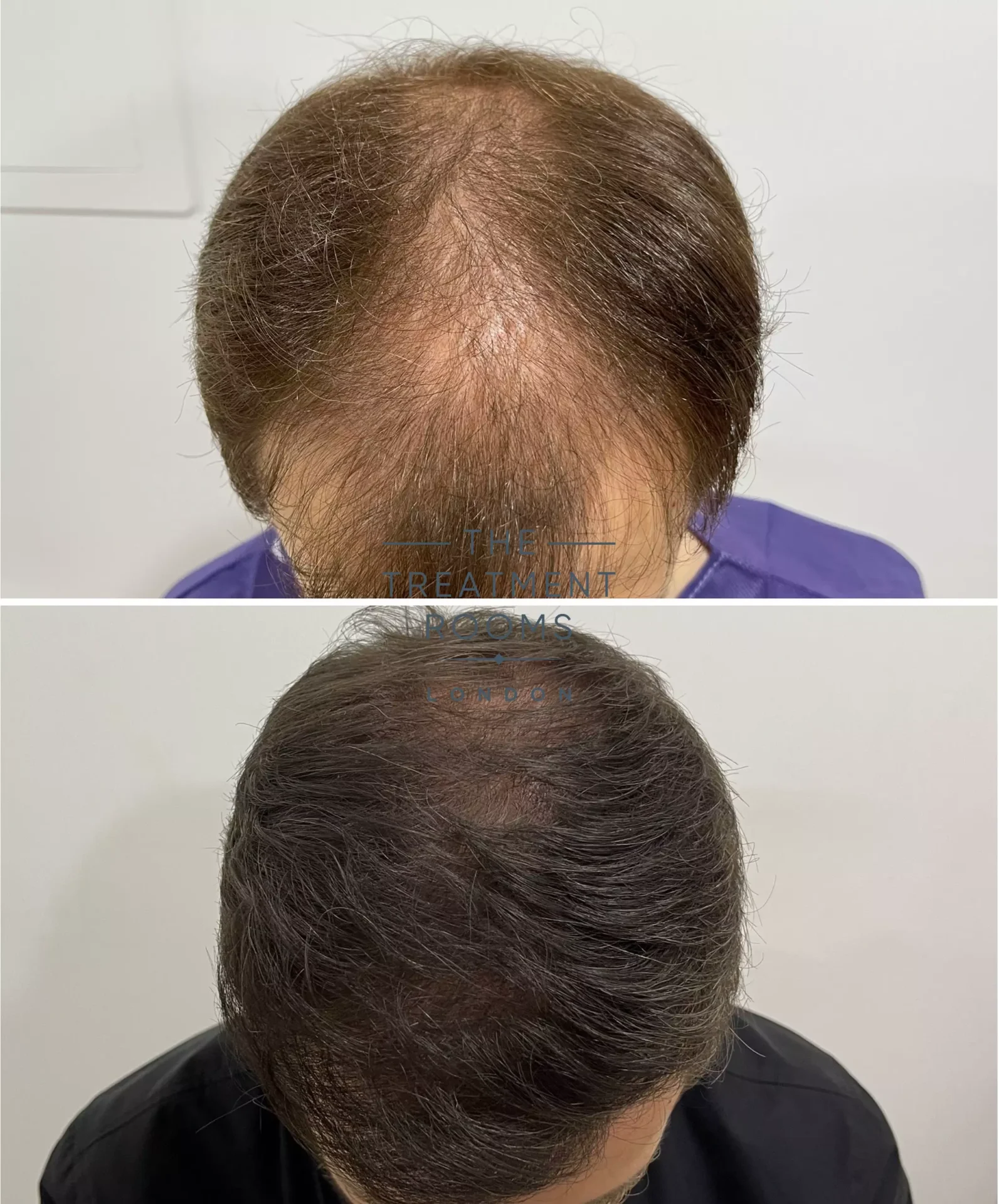 hair transplant UK before and after 1491 grafts