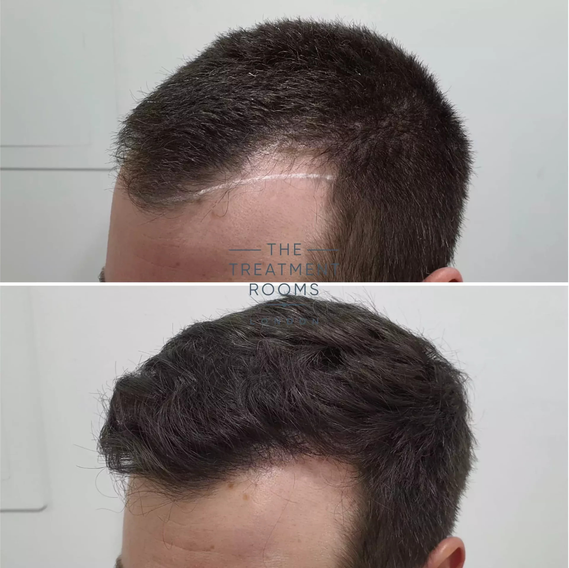 hair transplant before and after 1297 grafts