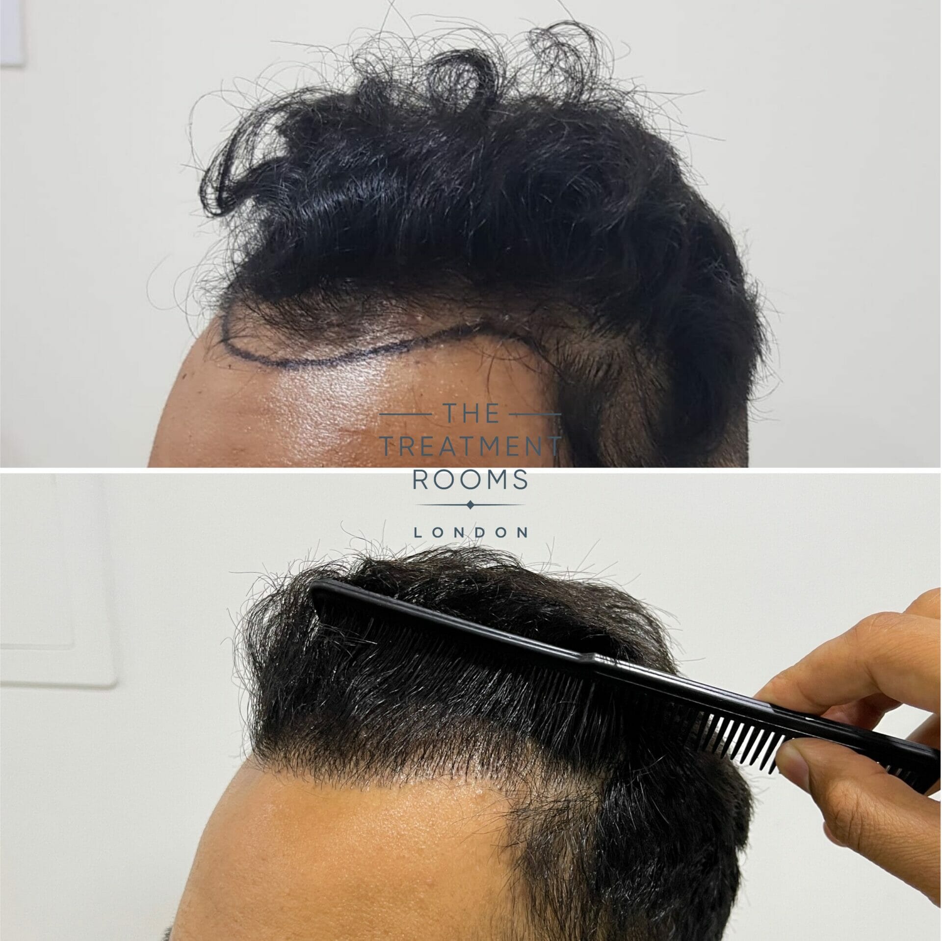hair transplant before and after 1397 grafts