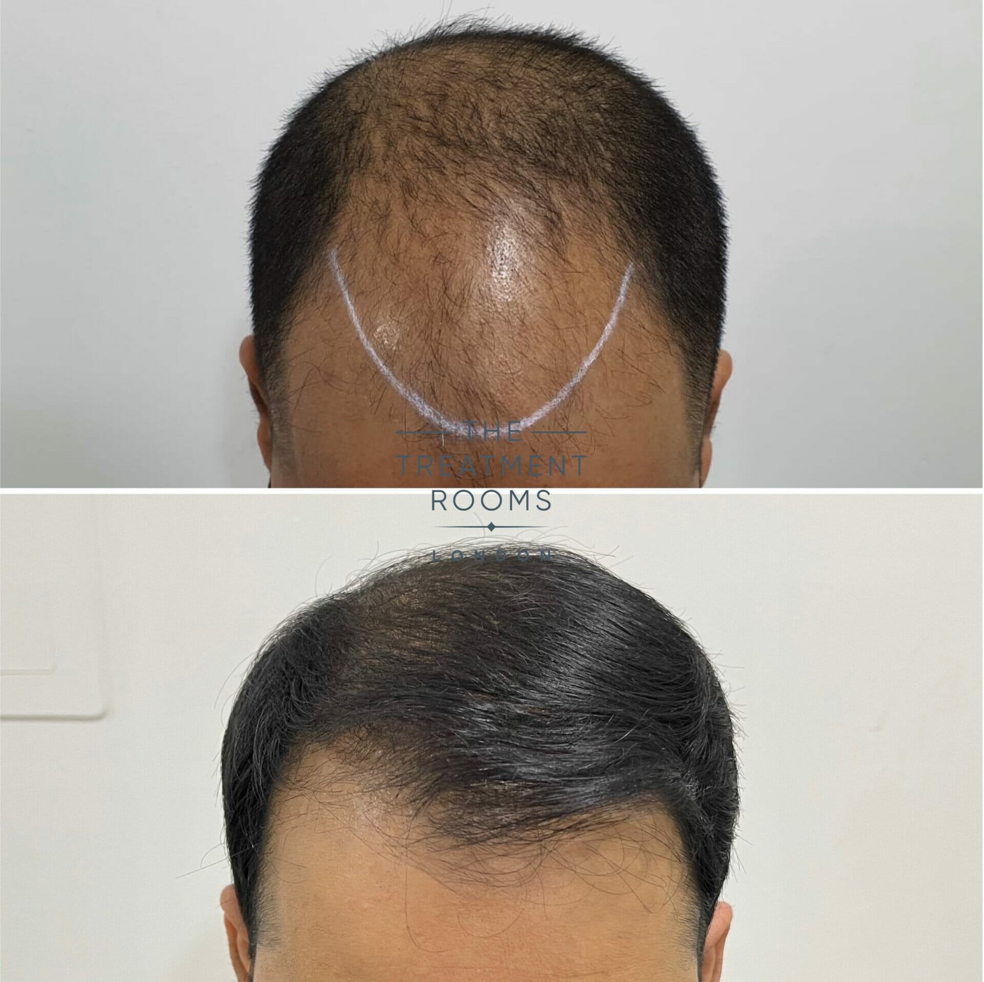 hair transplant before and after 1911