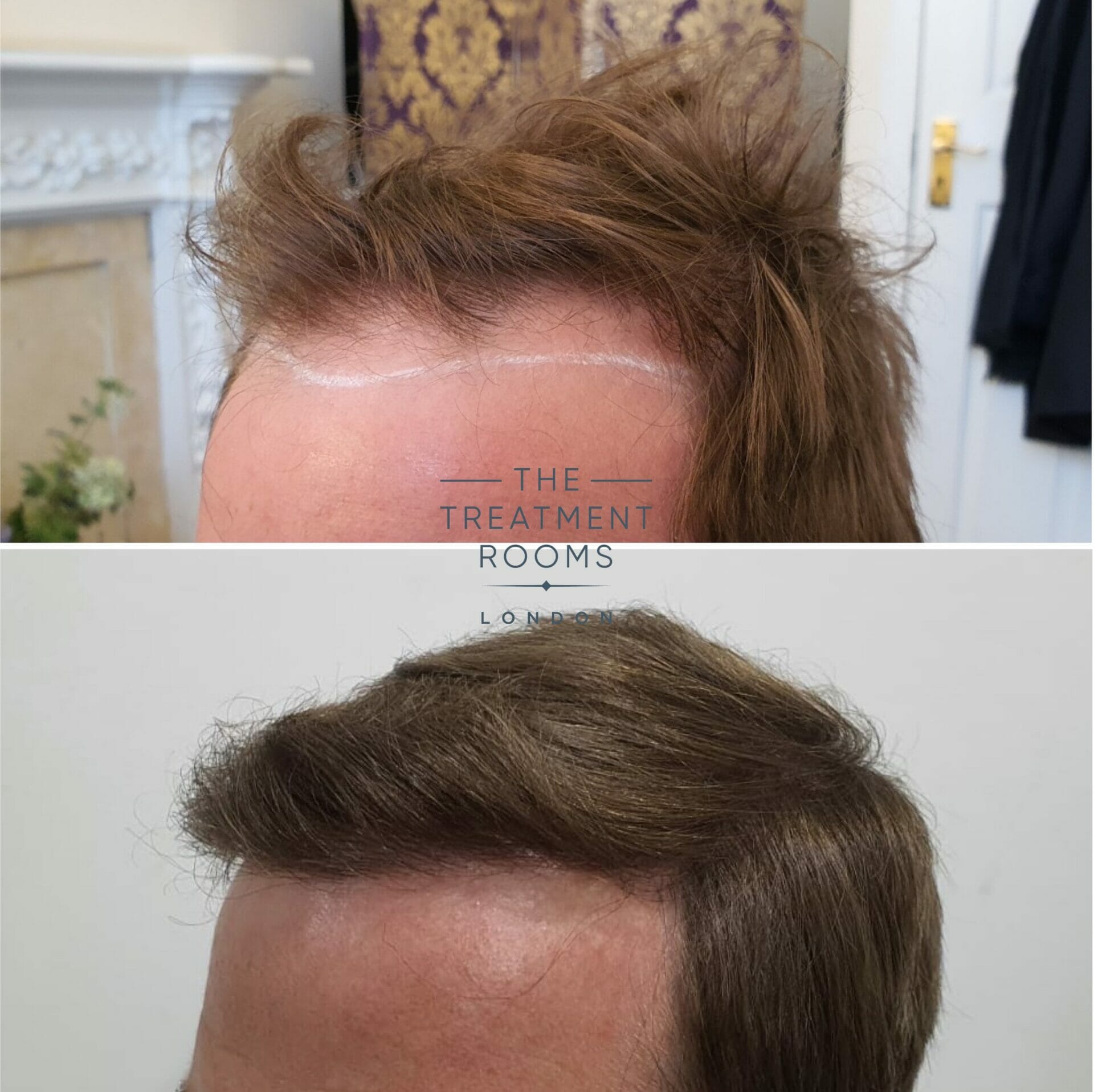 hair transplant before and after 2018 grafts
