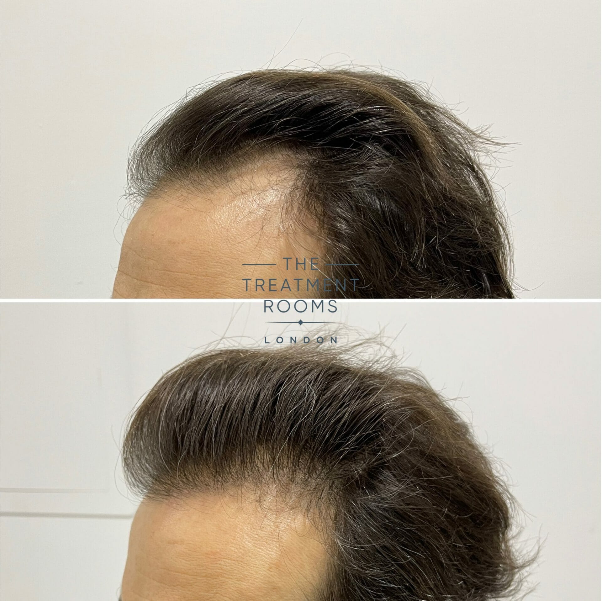 hair transplant before and after hairline 1840 grafts