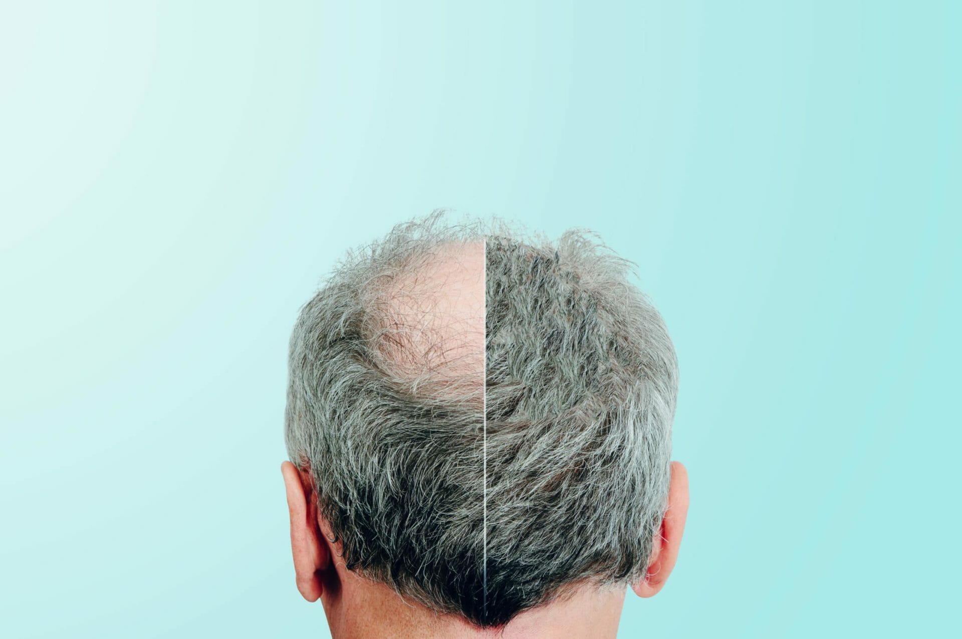 Before and after, Rear view of a male head without hair. Hair loss concept, bird's nest on the head. Problems with hair regrowth, shampoo for facial hair growth.