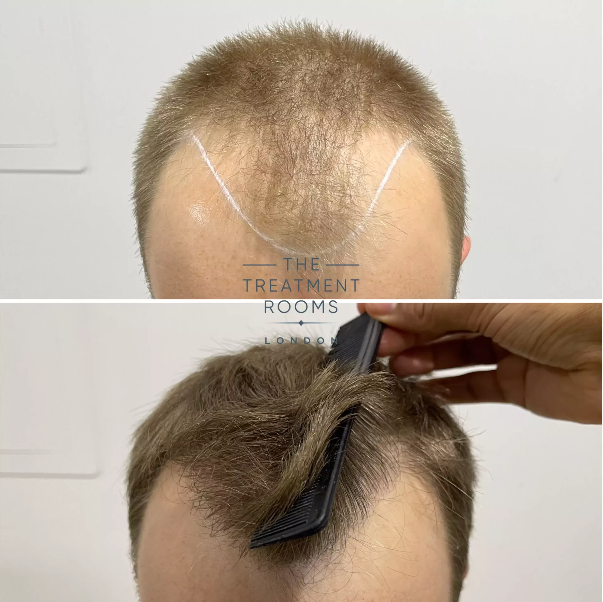 hair transplant clinic 1756 result