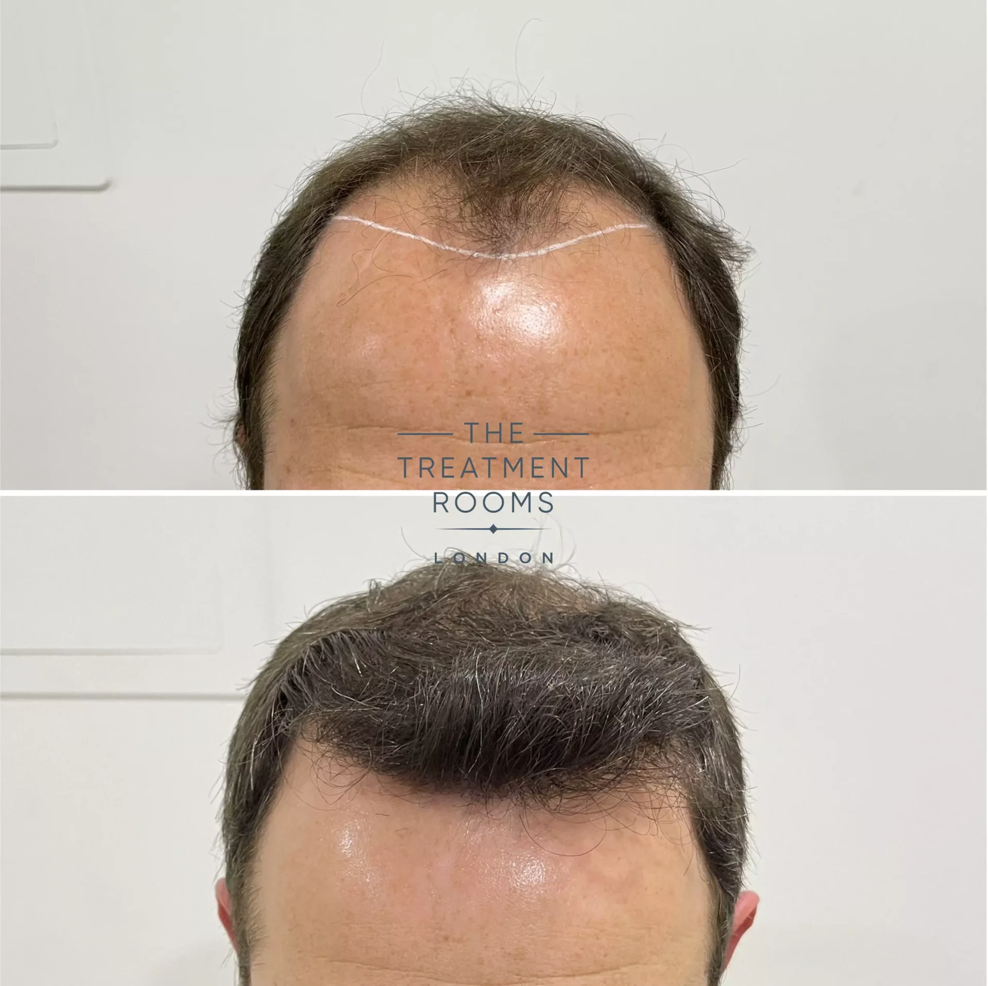 hair transplant clinic 2076 grafts before and after