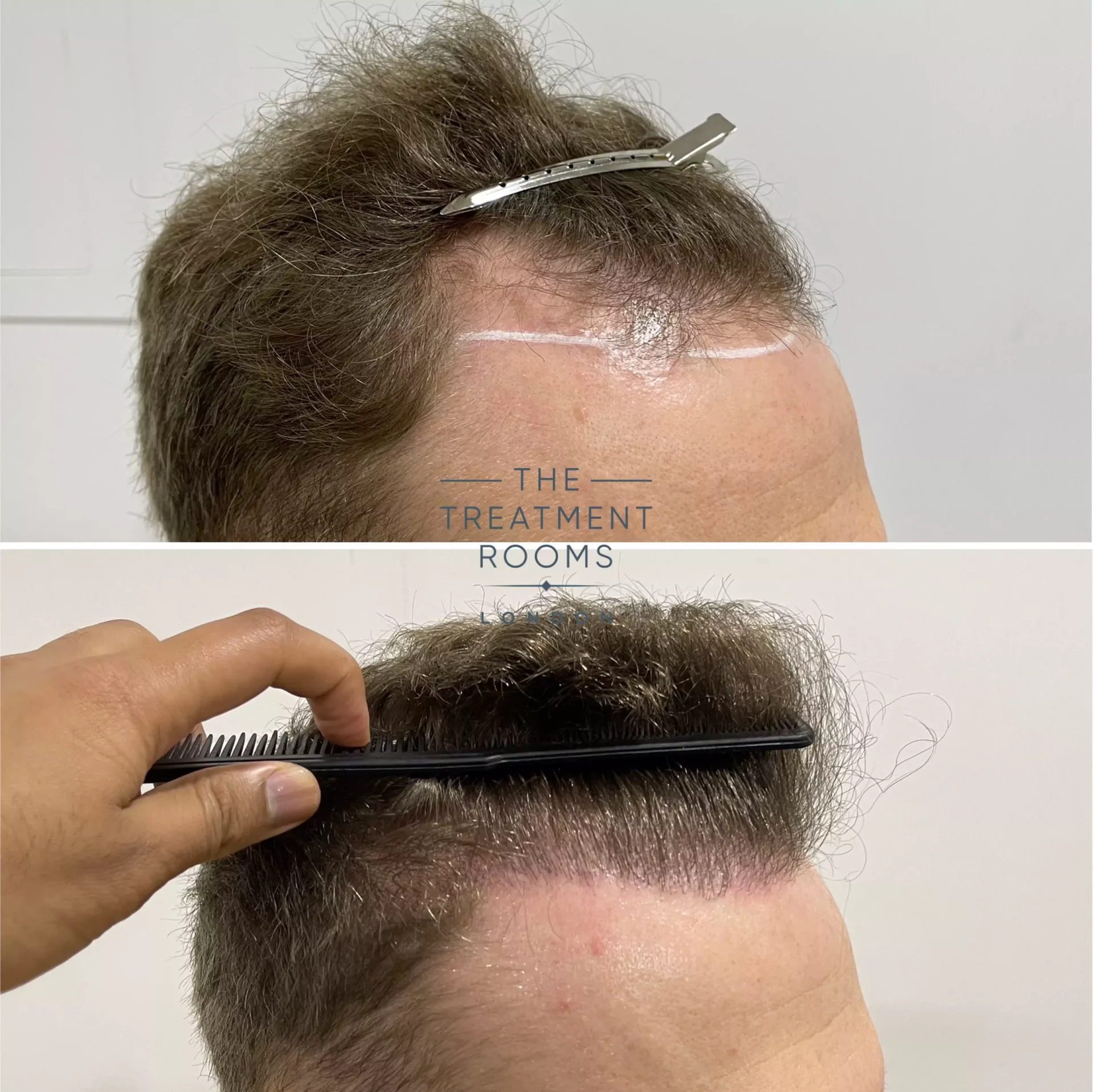 hair transplant clinic UK 1346 grafts before and after