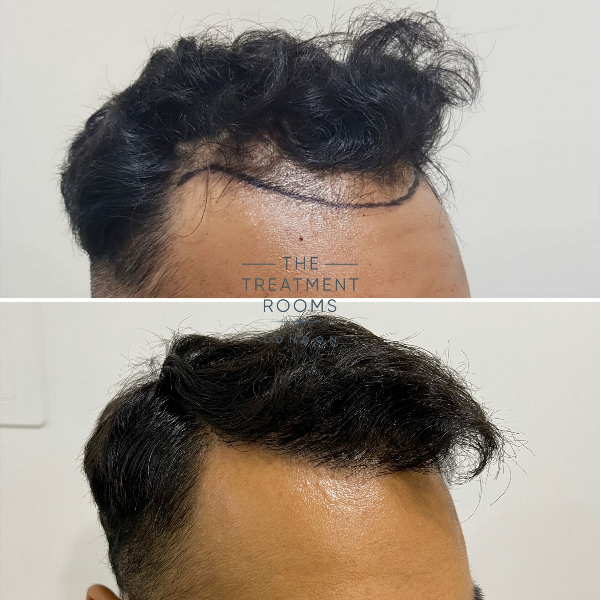 hair transplant clinic before and after 1397 grafts
