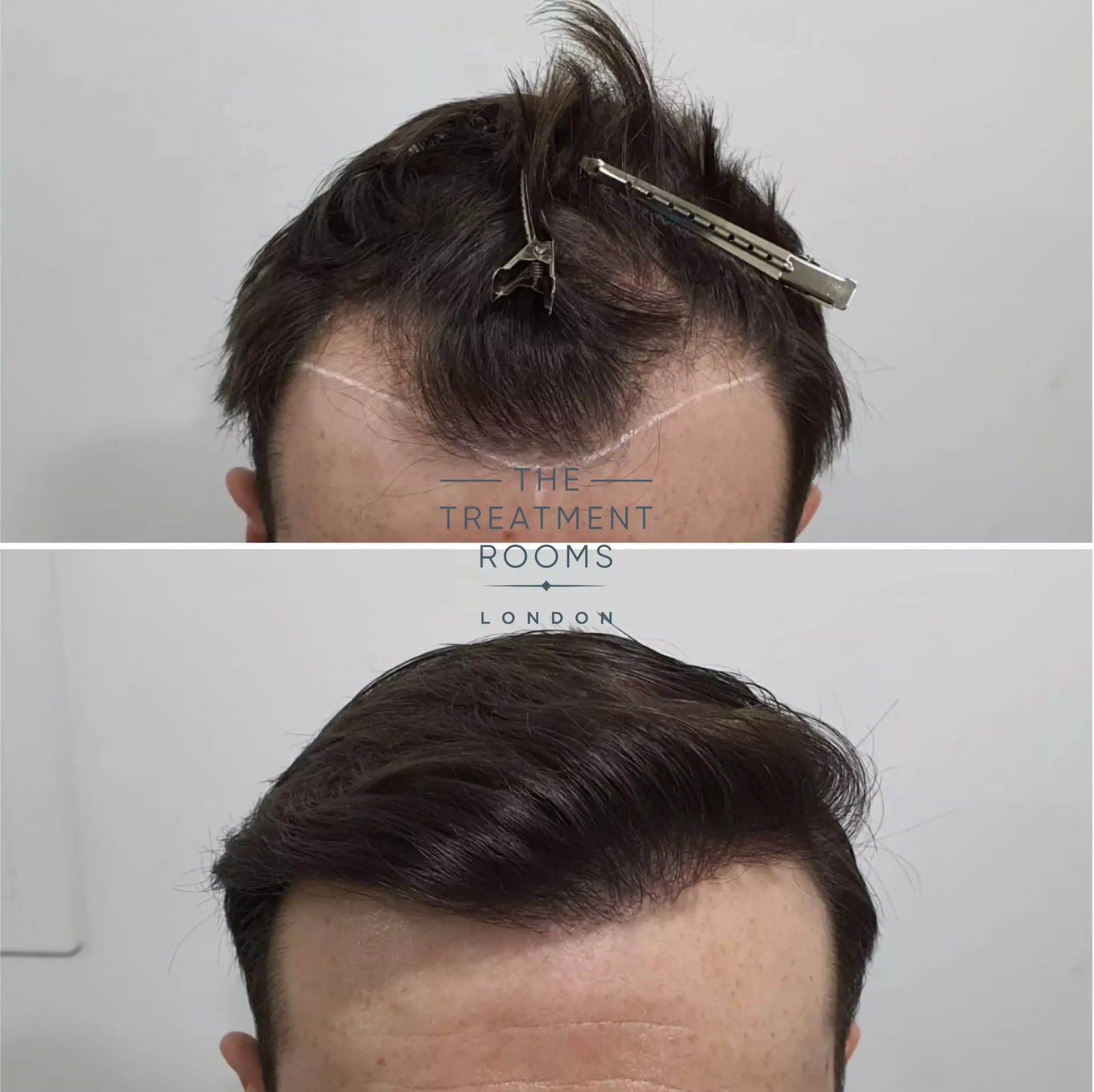 hair transplant clinic london 1014 grafts result