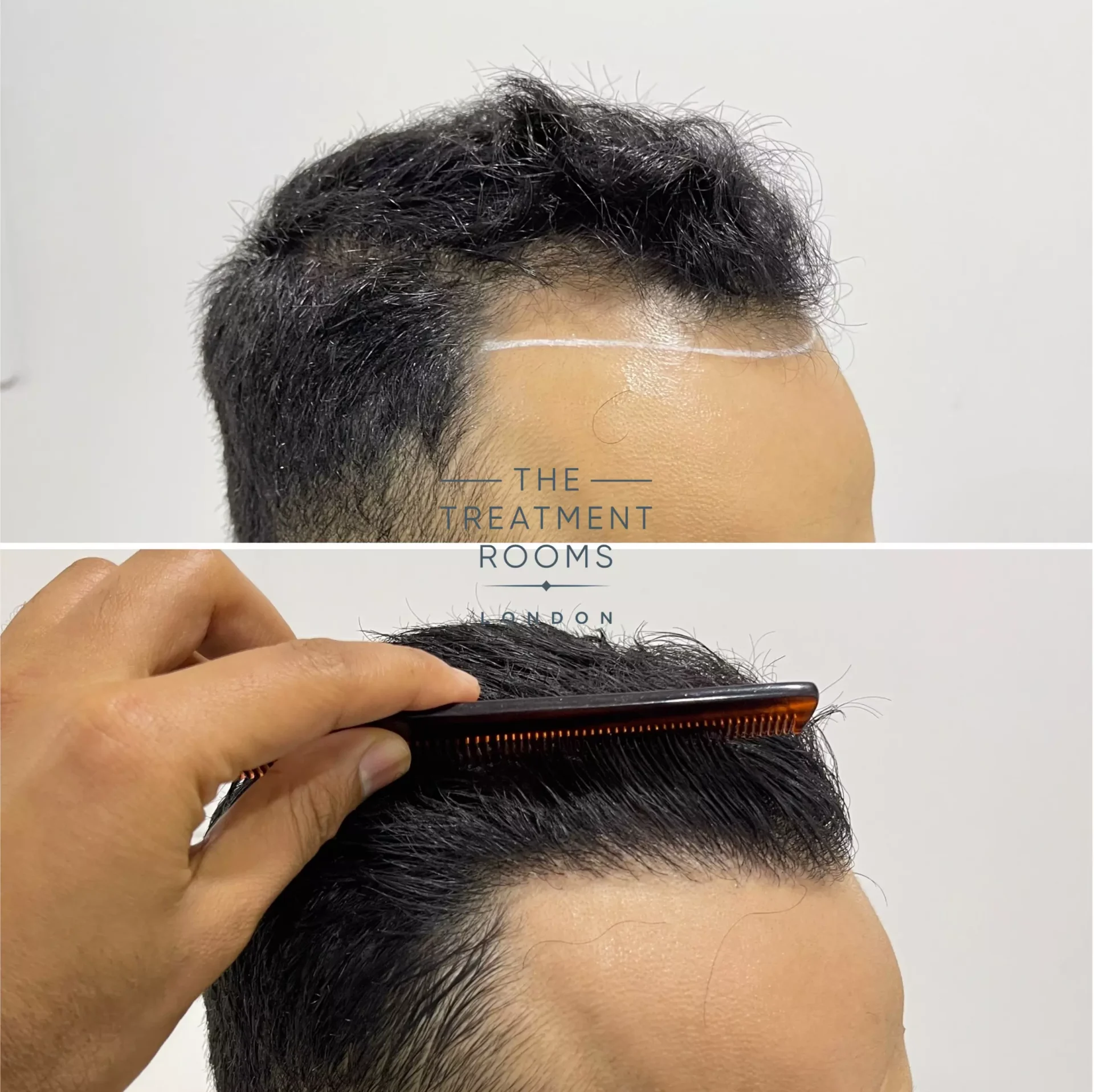 hair transplant clinic london 1274 grafts before and after