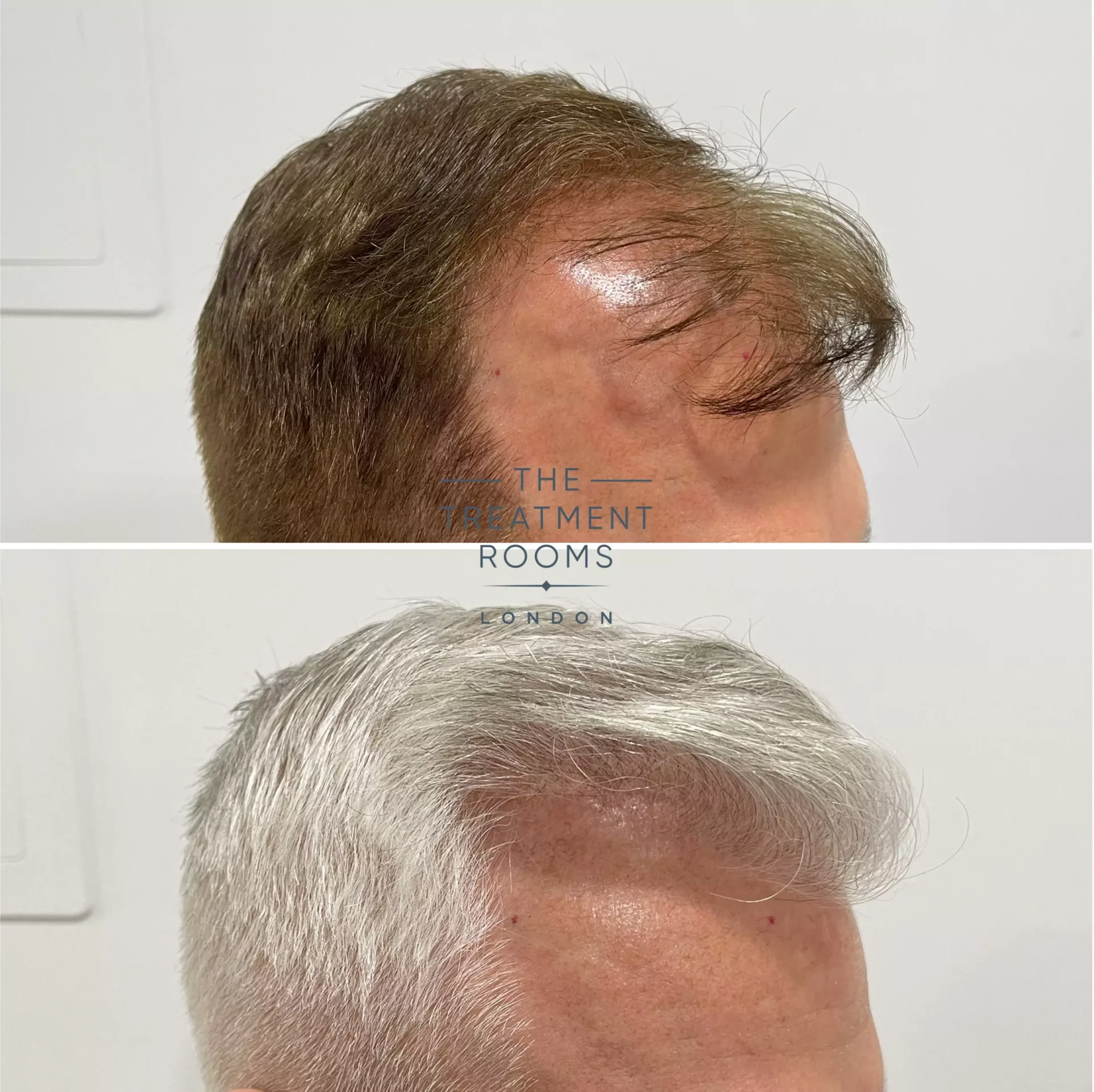 hair transplant clinic london 1495 grafts before and after