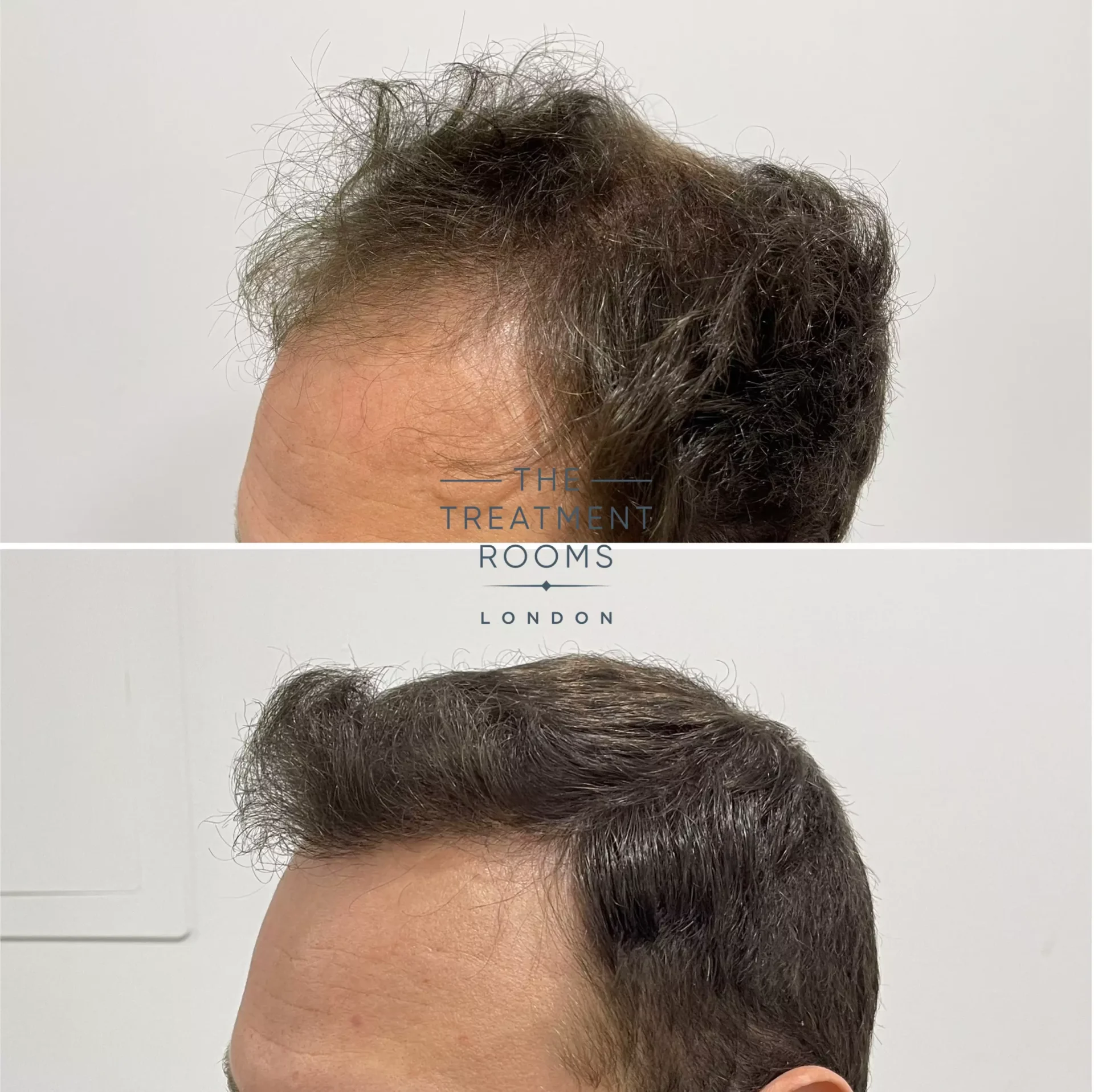 hair transplant clinic london 1736 grafts before and after