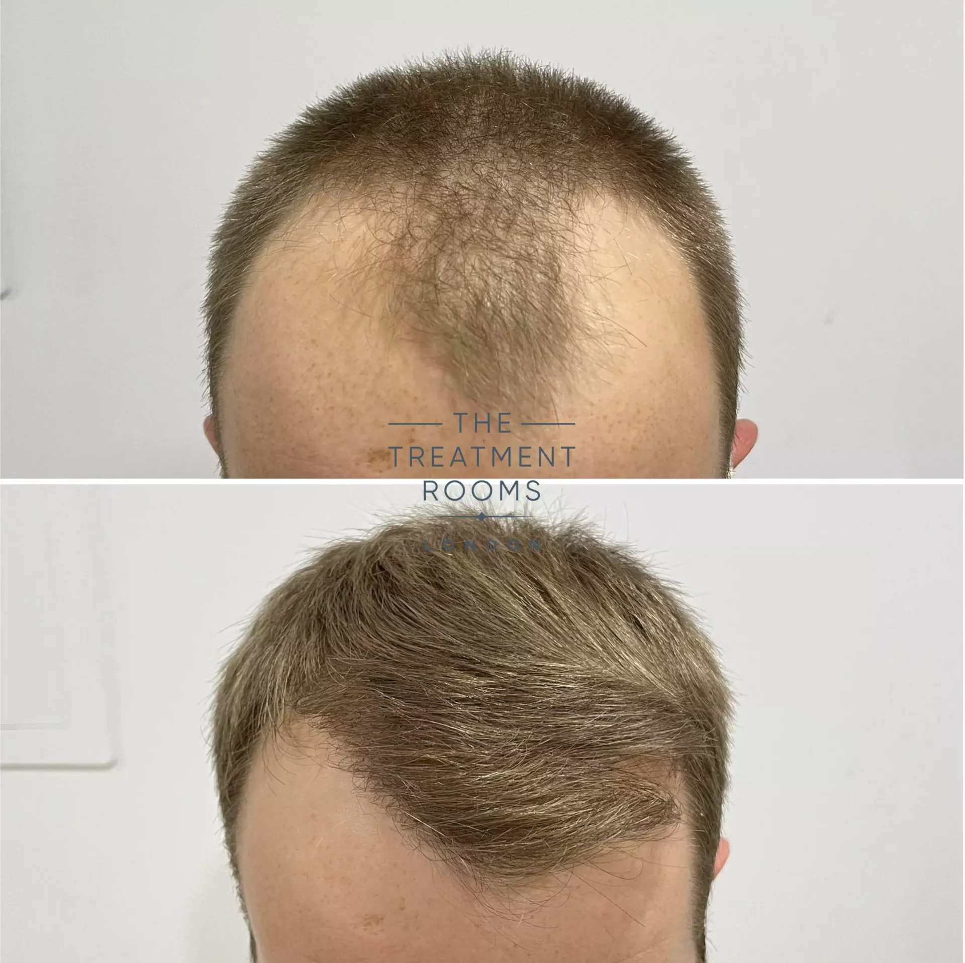 hair transplant clinic london 1756 grafts before and after