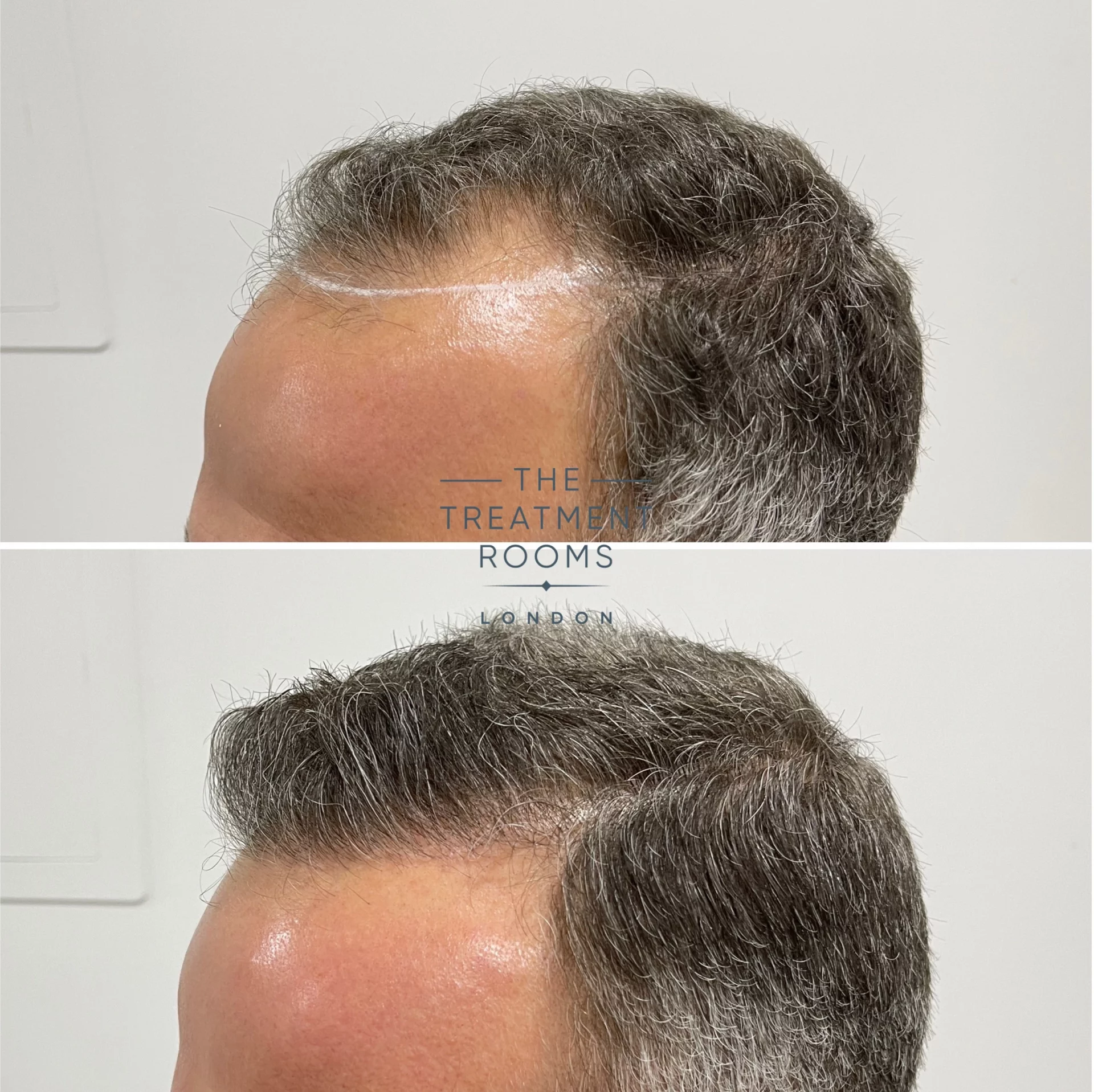 hair transplant clinic london 1788 grafts hairline result