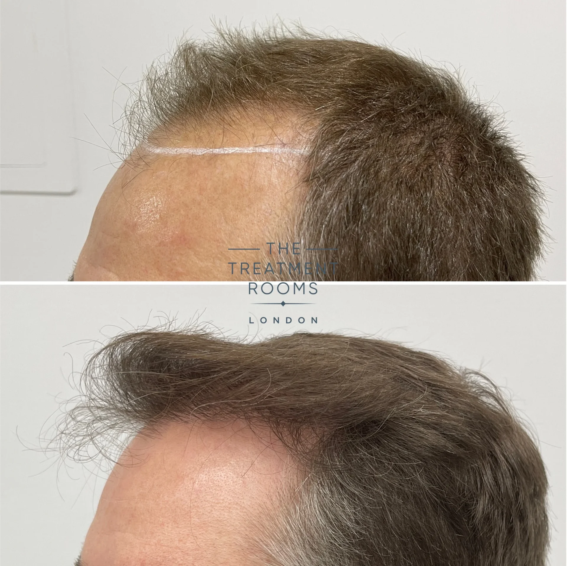 hair transplant clinic london 1839 grafts before and after