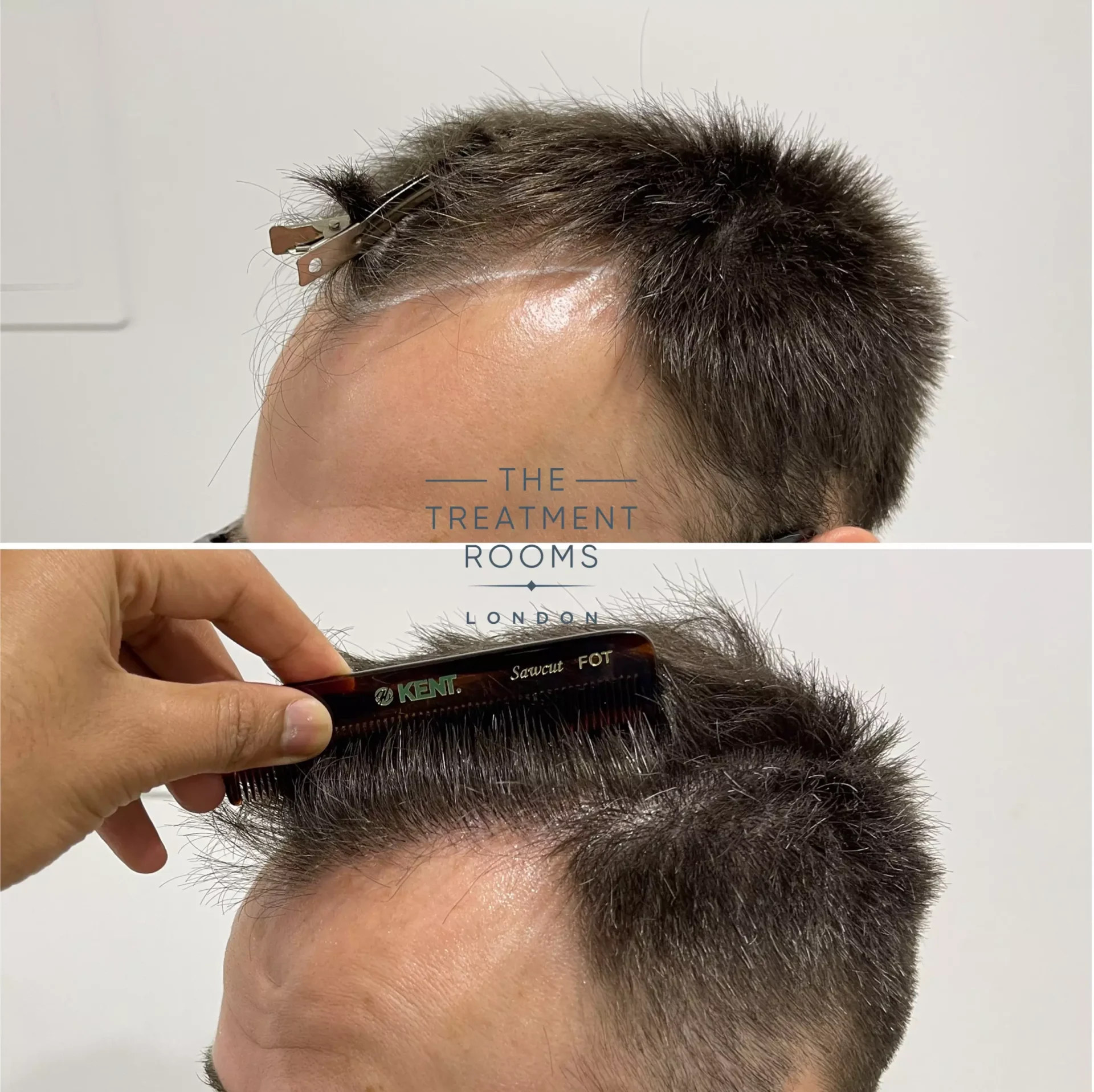 hair transplant clinic london 1930 grafts before and after crown and hairline