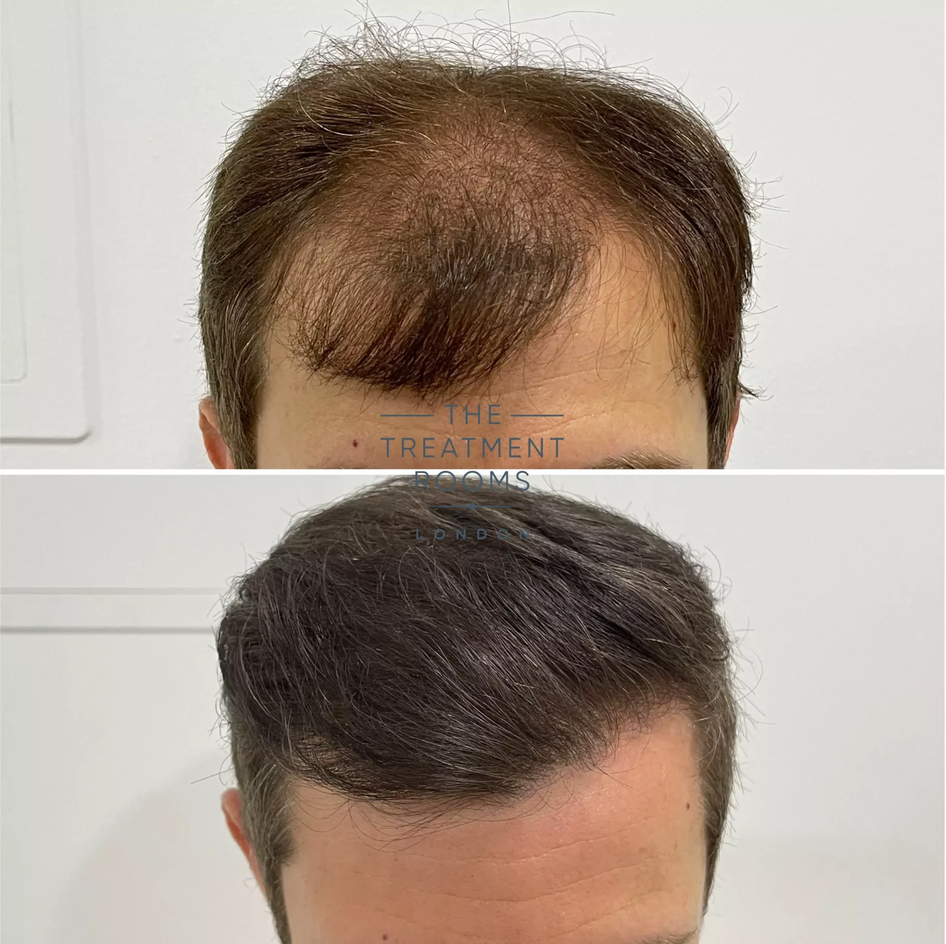 hair transplant clinic london before and after 1491 grafts