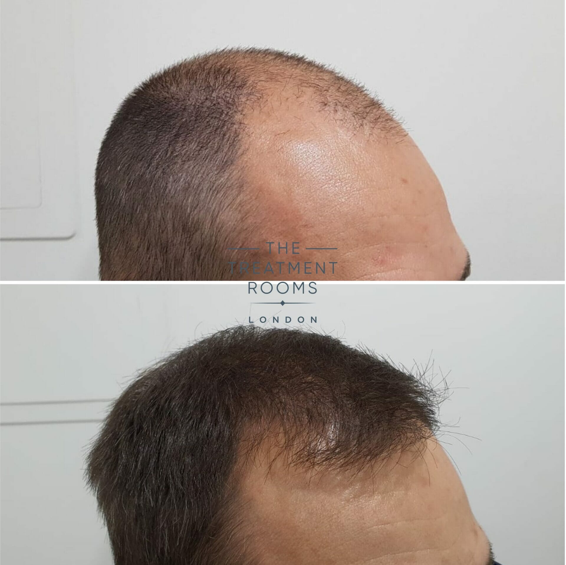 hair transplant clinic london before and after hair surgery