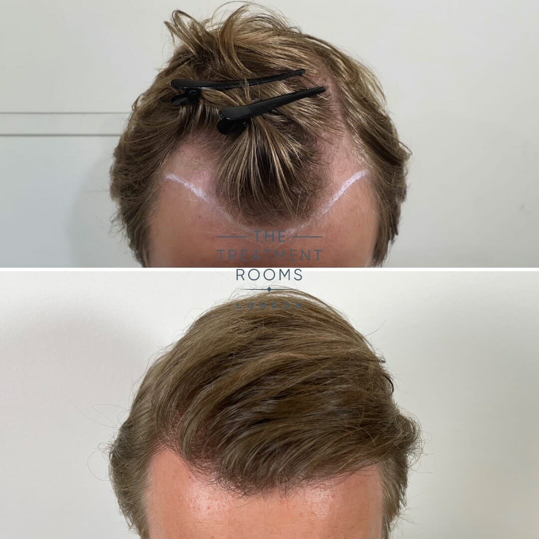 hair transplant clinic london before and after hairline surgery