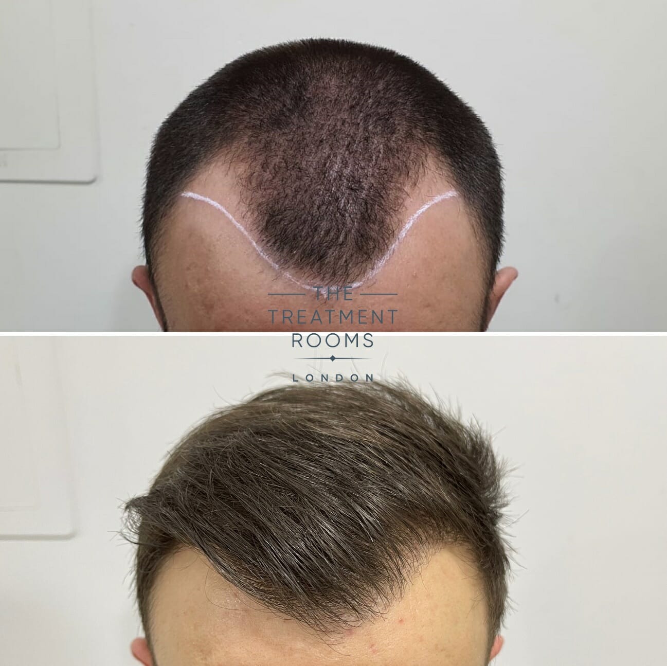 hair transplant cost london