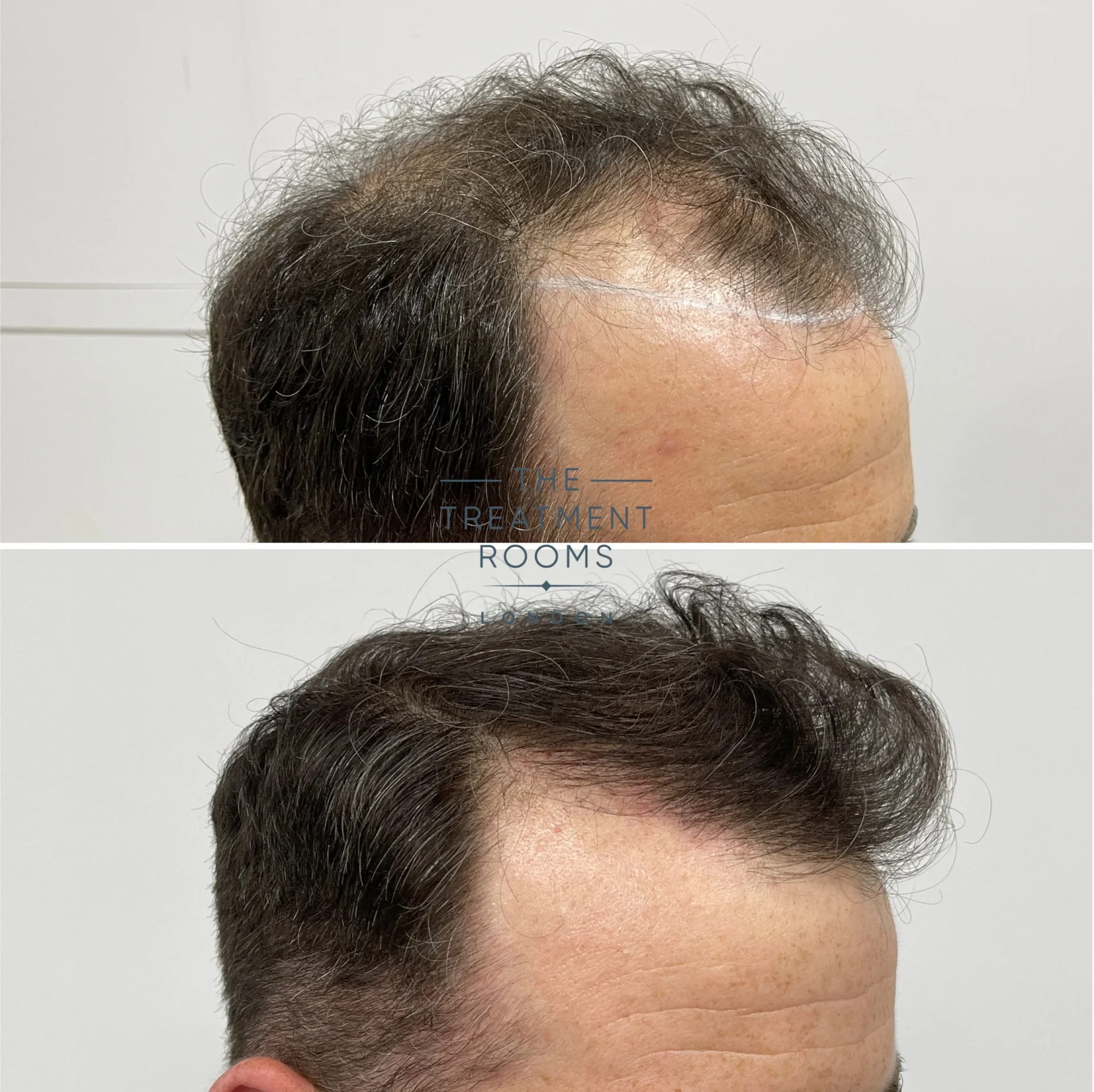hair transplant hairline before and after 1521 grafts