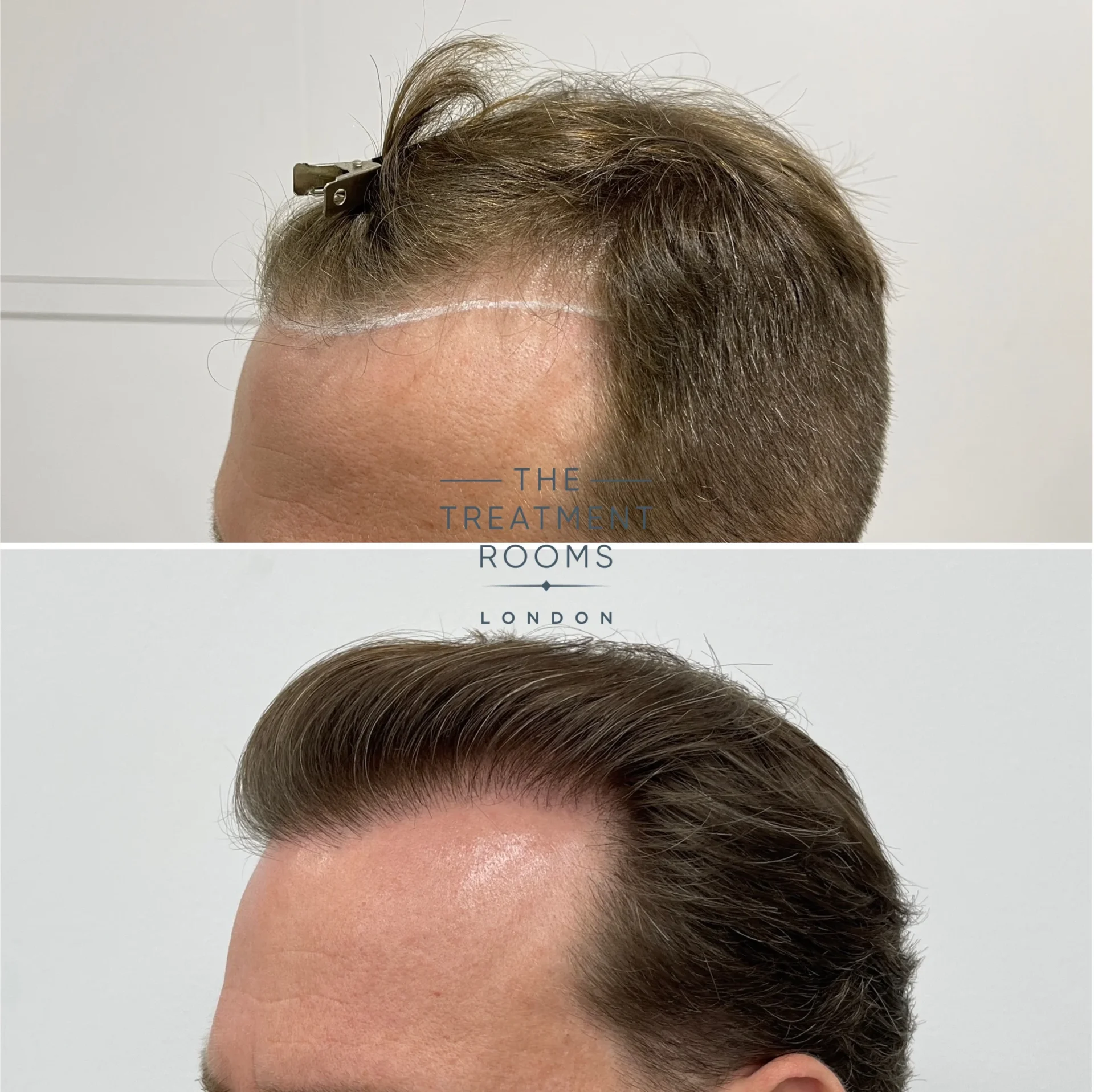 hair transplant hairline before and after 1566 grafts