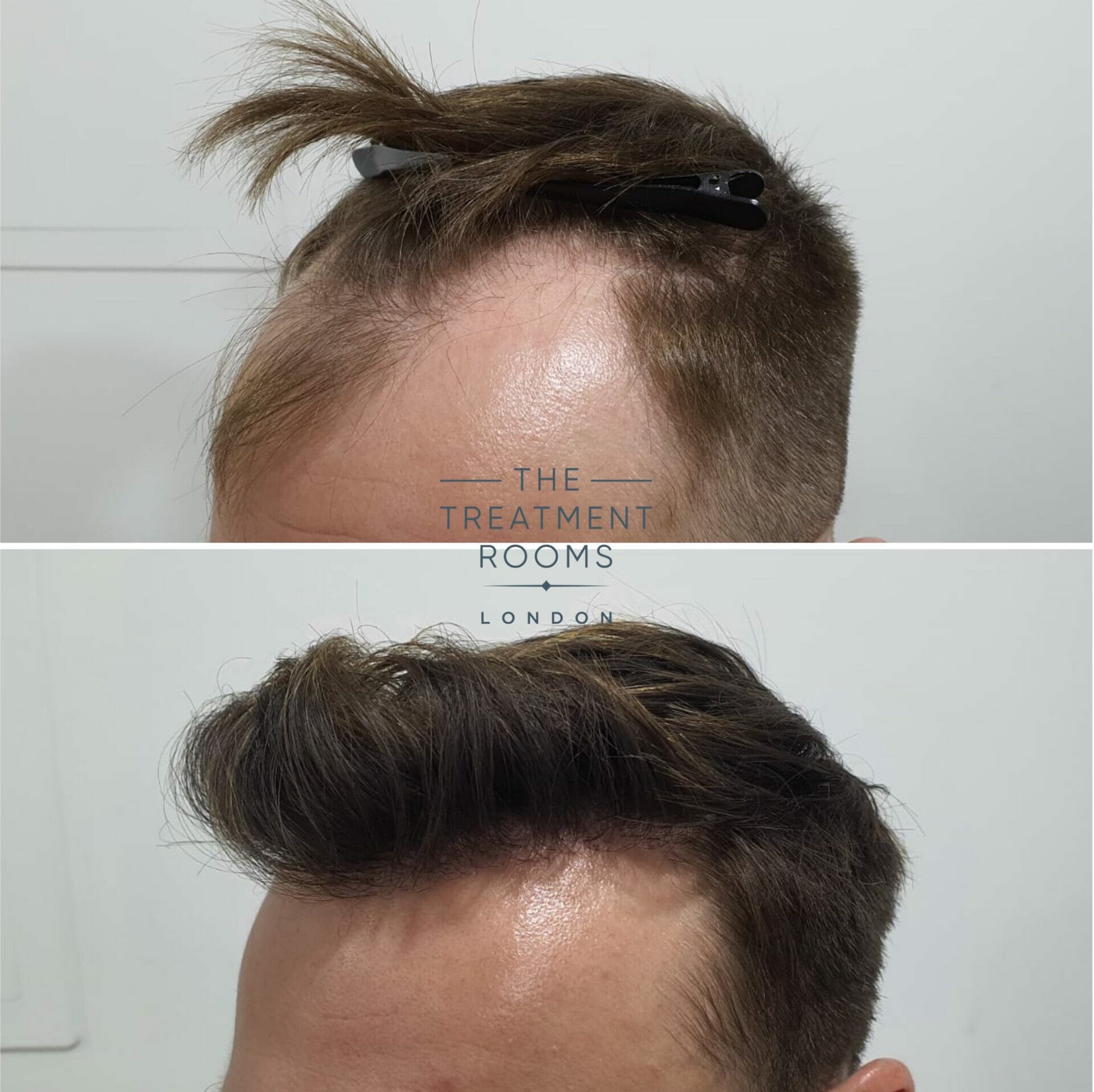 hair transplant hairline before and after 1724 grafts