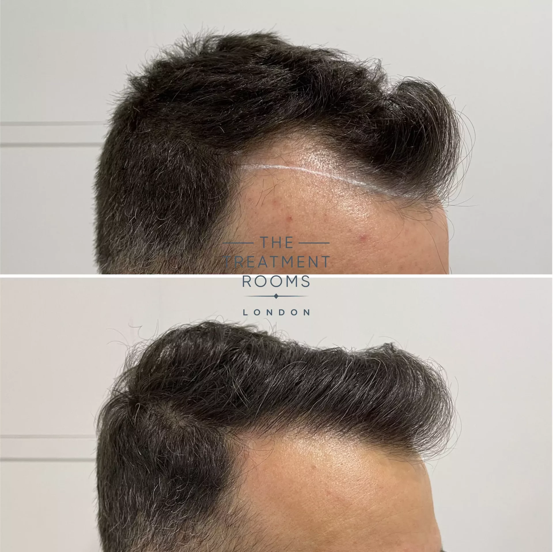 hair transplant london 1321 grafts before and after