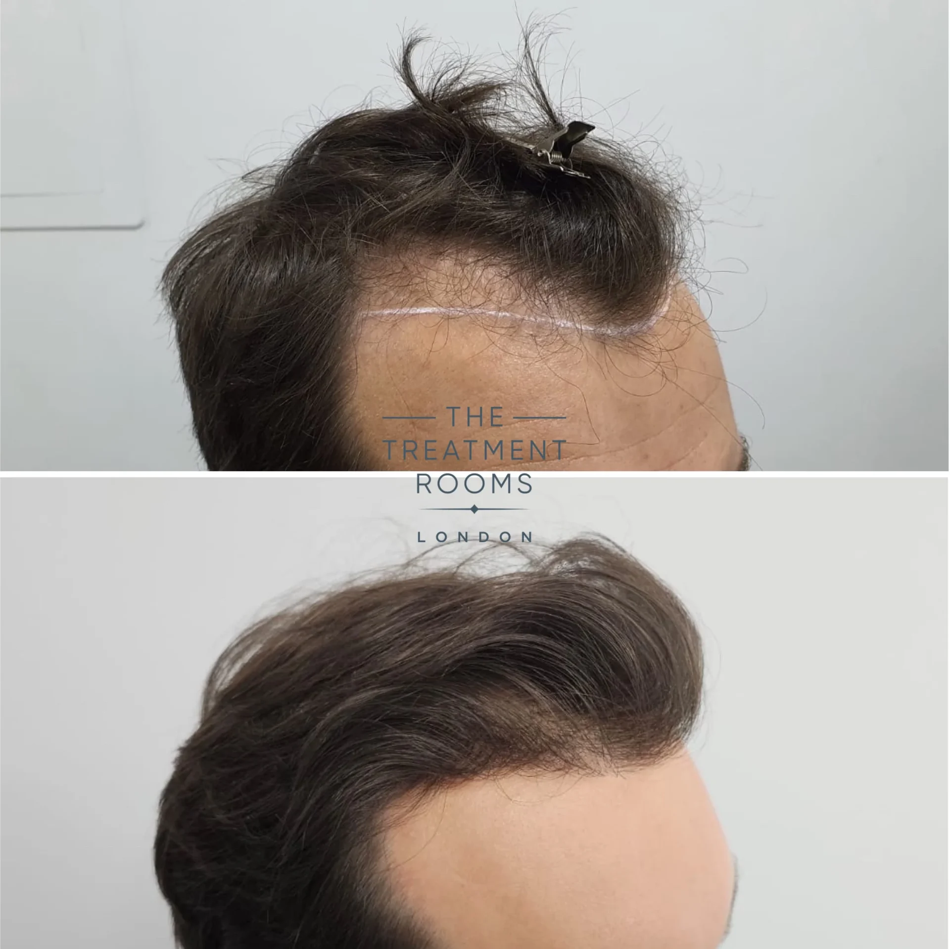 hair transplant london 1385 grafts before and after