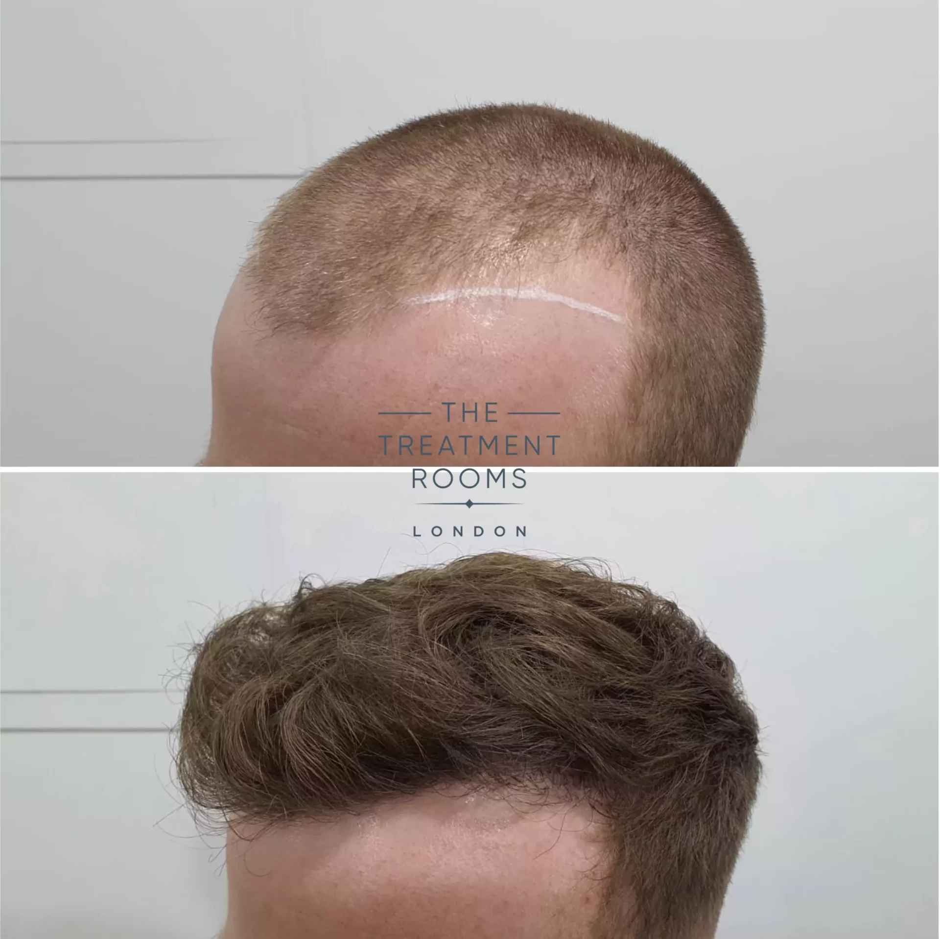 hair transplant london 1539 grafts before and after