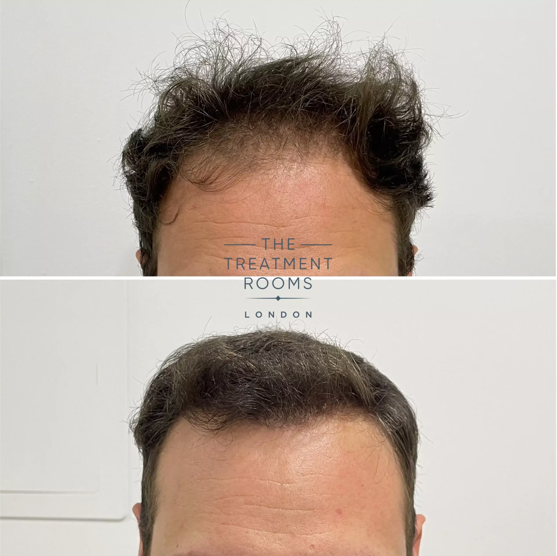 hair transplant london 1736 grafts before and after