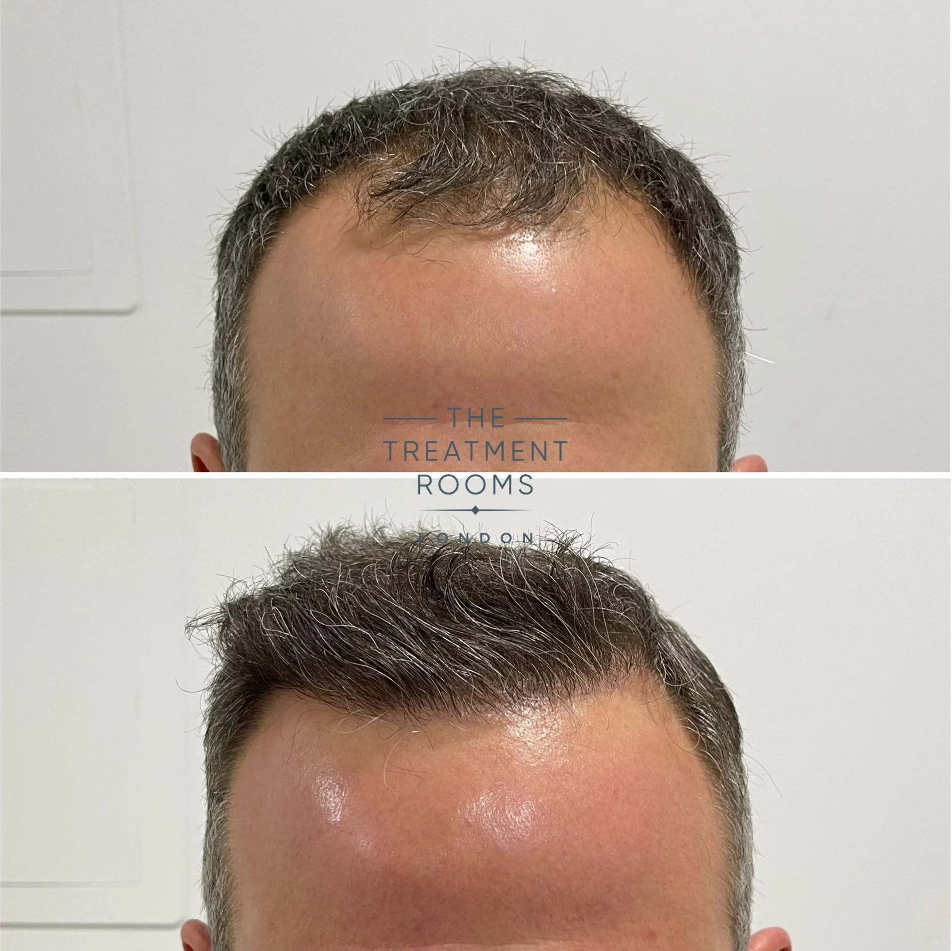 hair transplant london 1788 grafts before and after