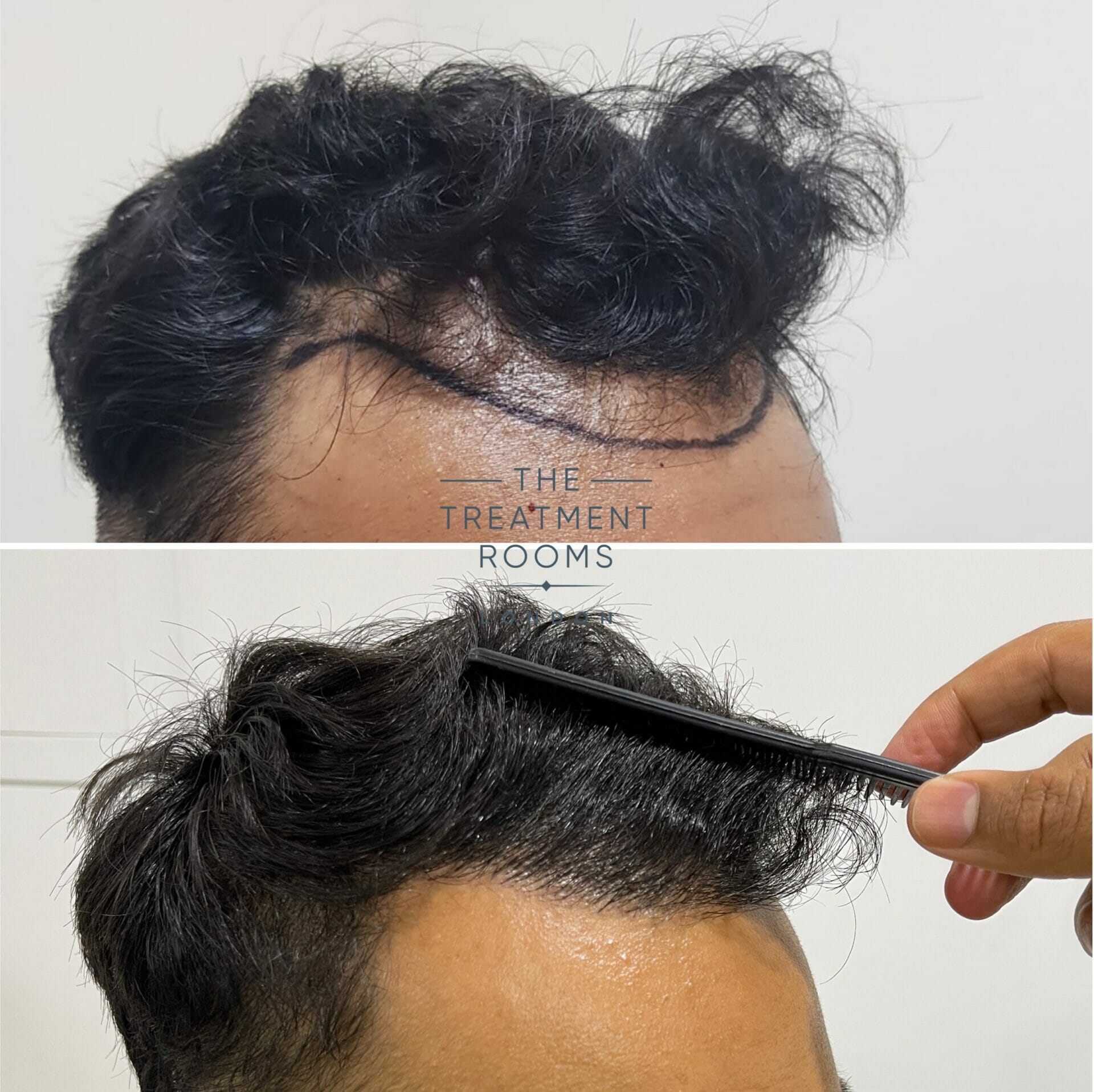 hair transplant london before and after 1397 grafts