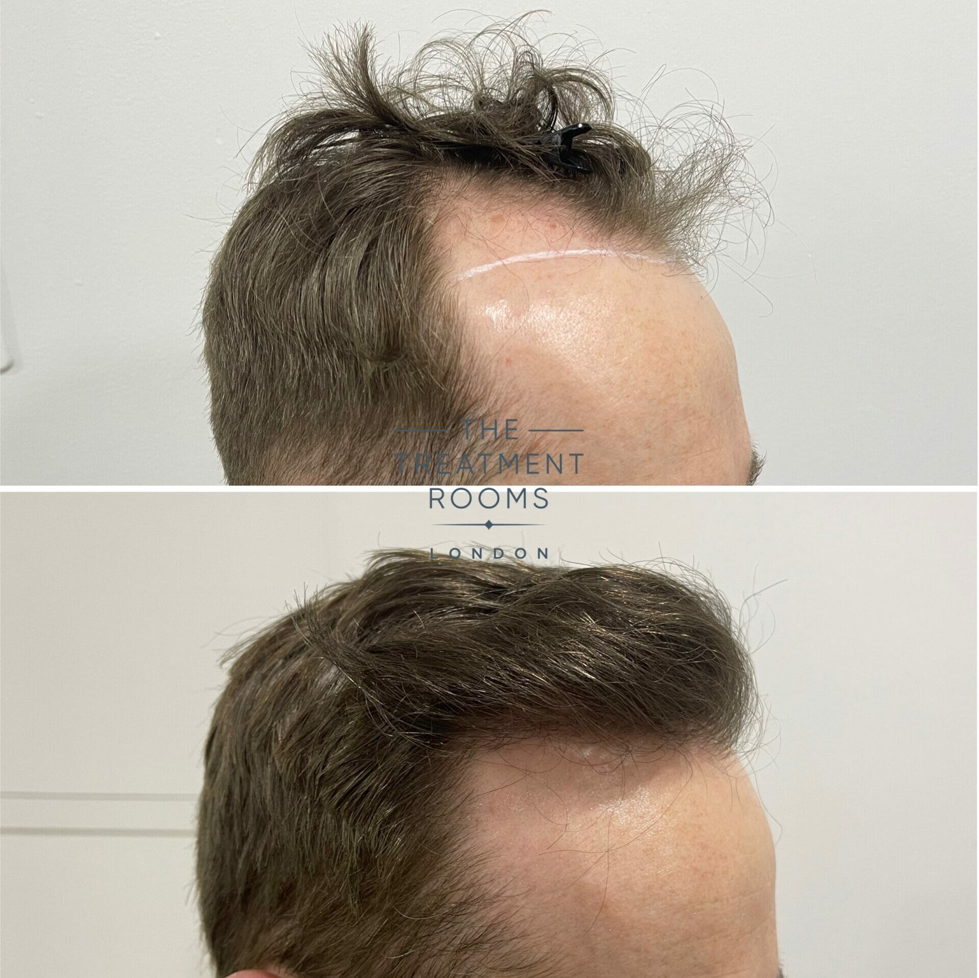 hair transplant london before and after