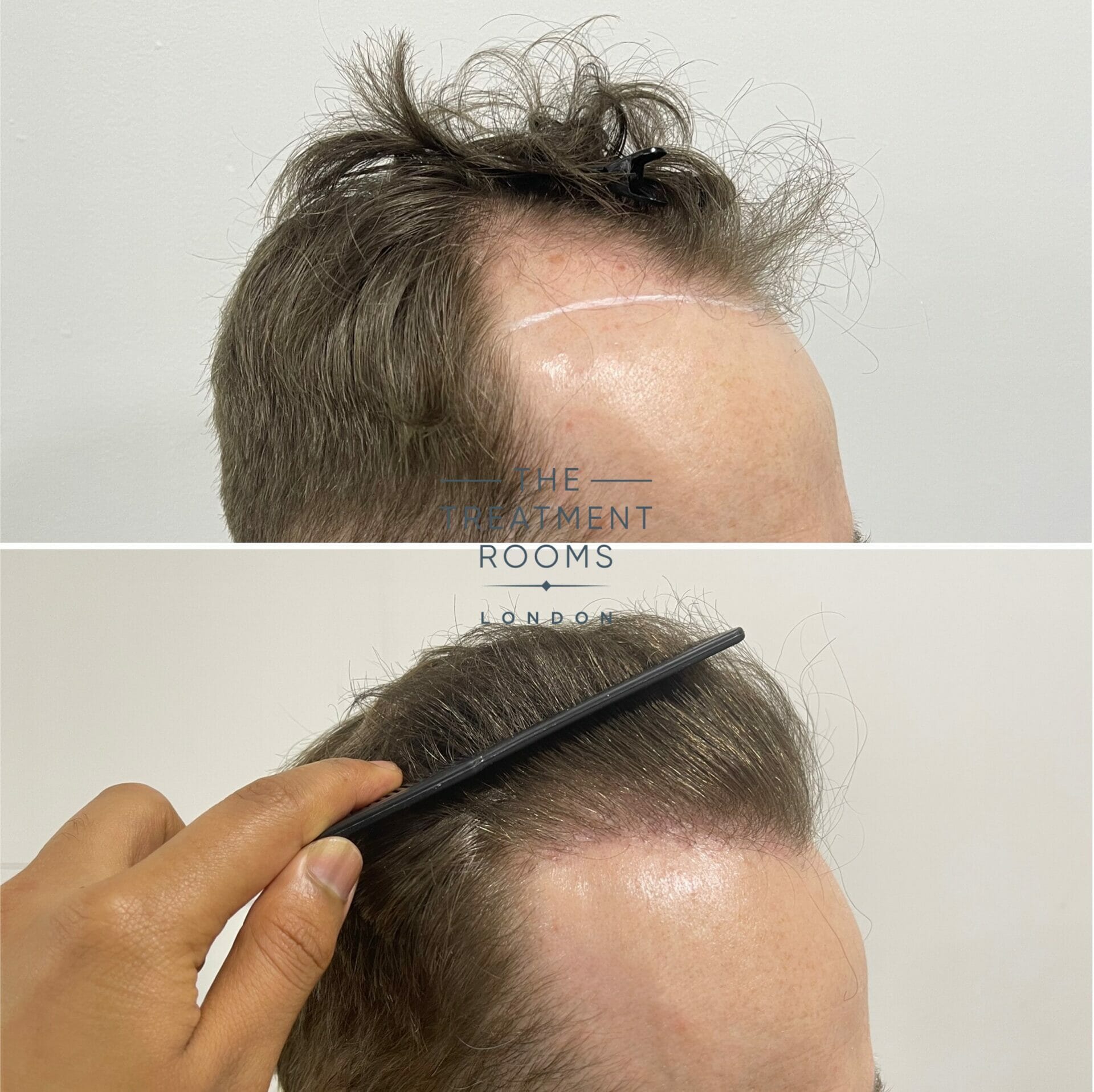 hair transplant london before and after close up