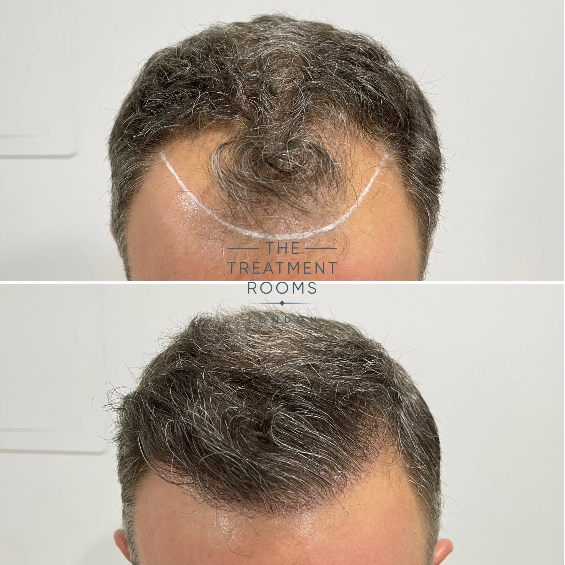 hair transplant london clinic reviews