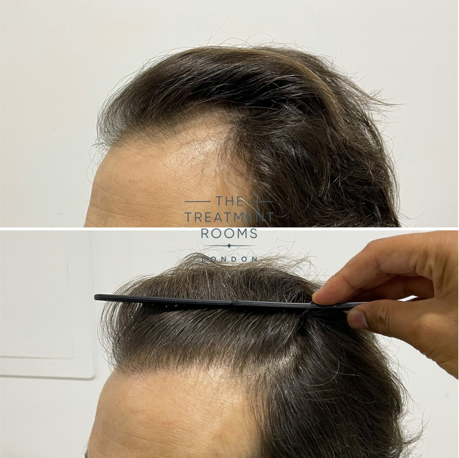 hair transplant london hairline 1840 grafts