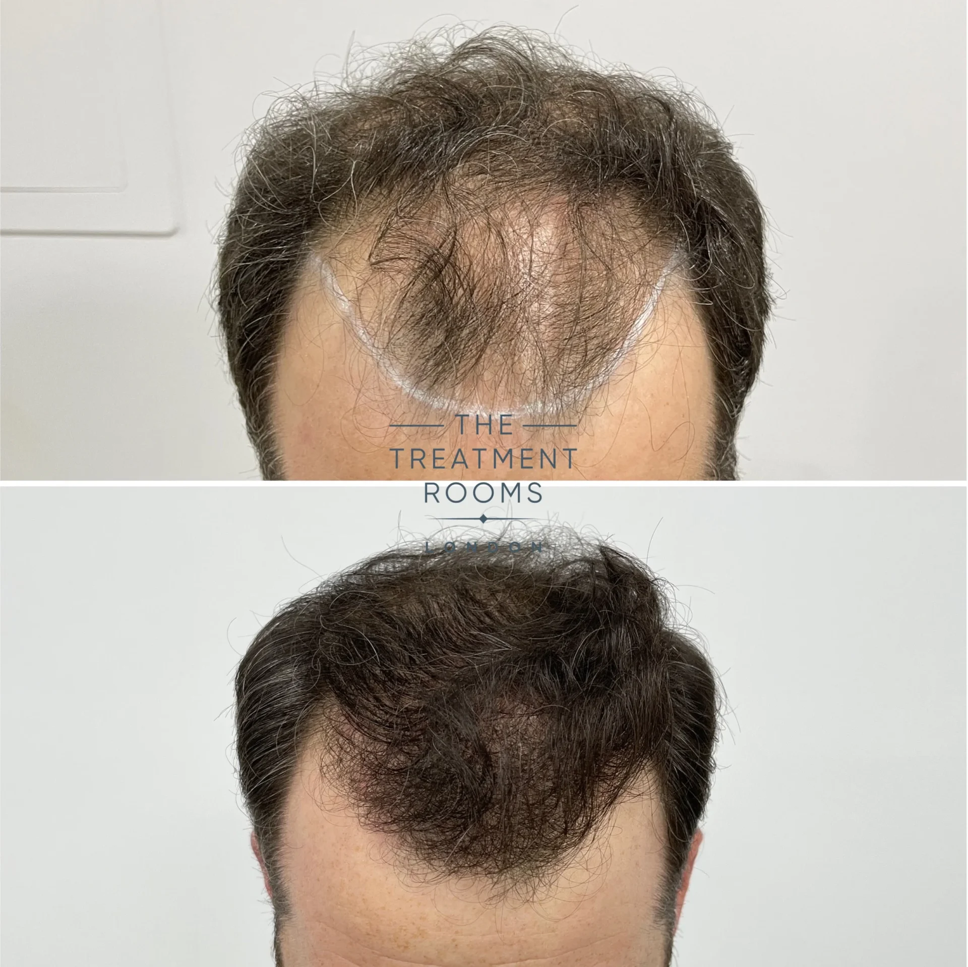hair transplant receding hairline before and after 1521 grafts