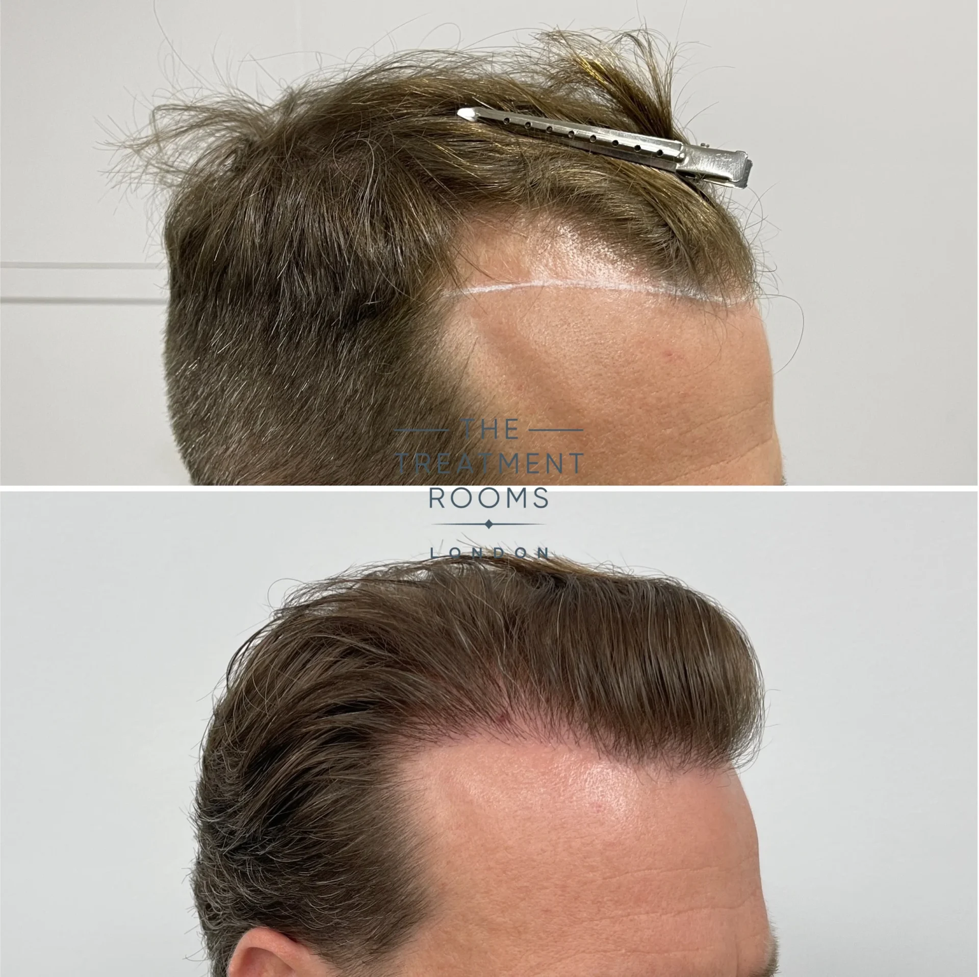 hair transplant receding hairline before and after 1566 grafts